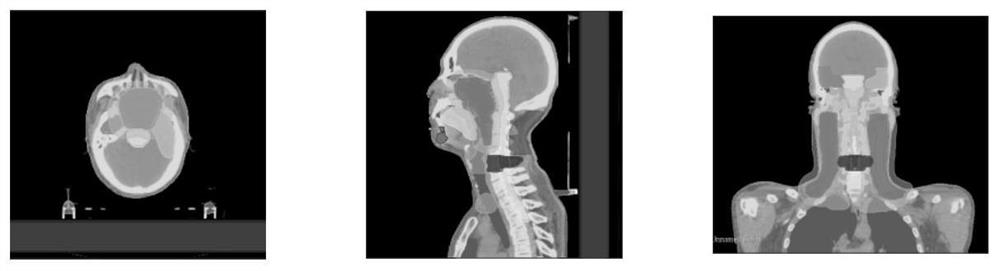 Three-dimensional dose distribution prediction method for intensity-modulated radiotherapy planning based on deep network learning