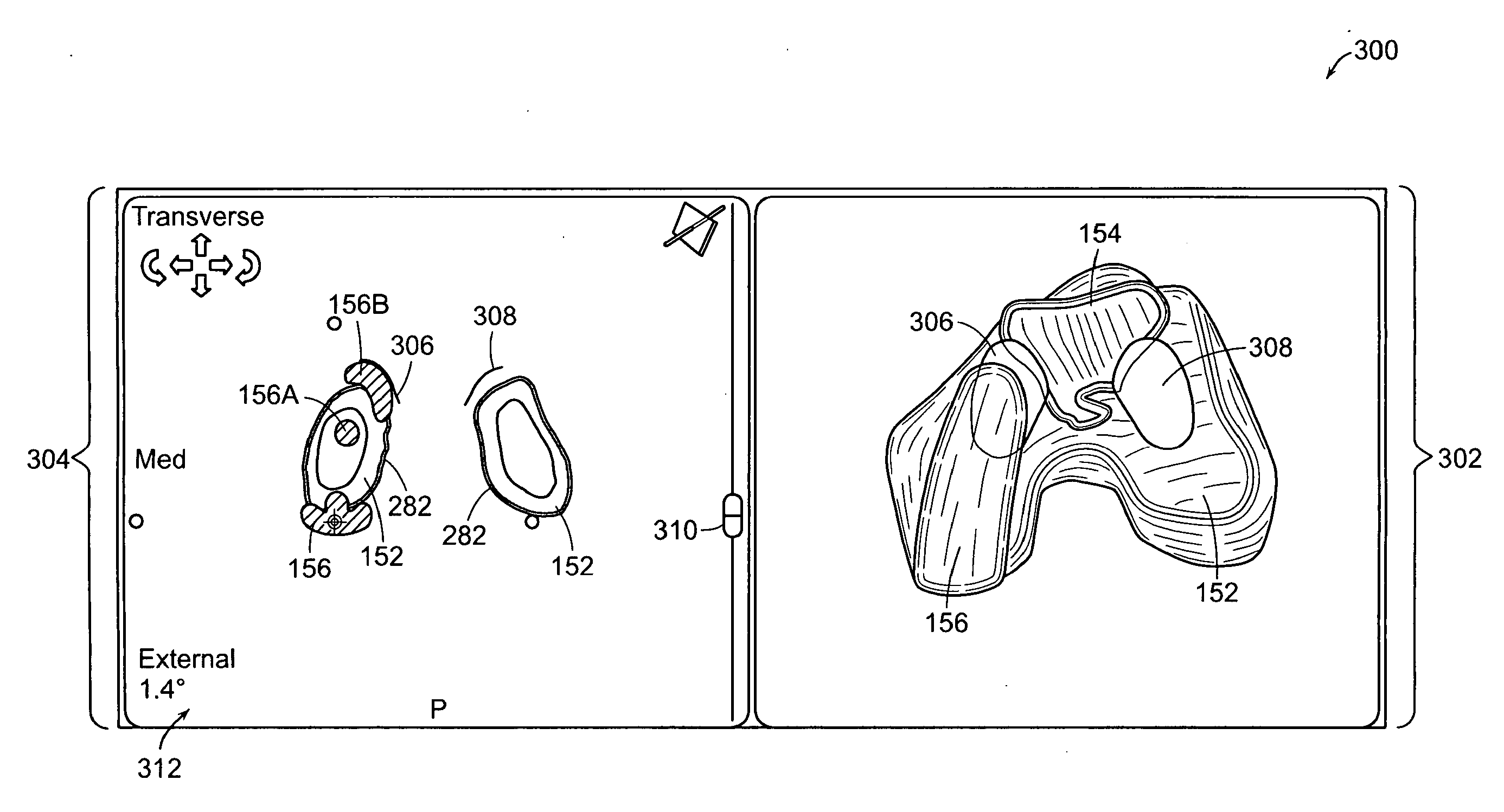 Implant Planning for Multiple Implant Components Using Constraints