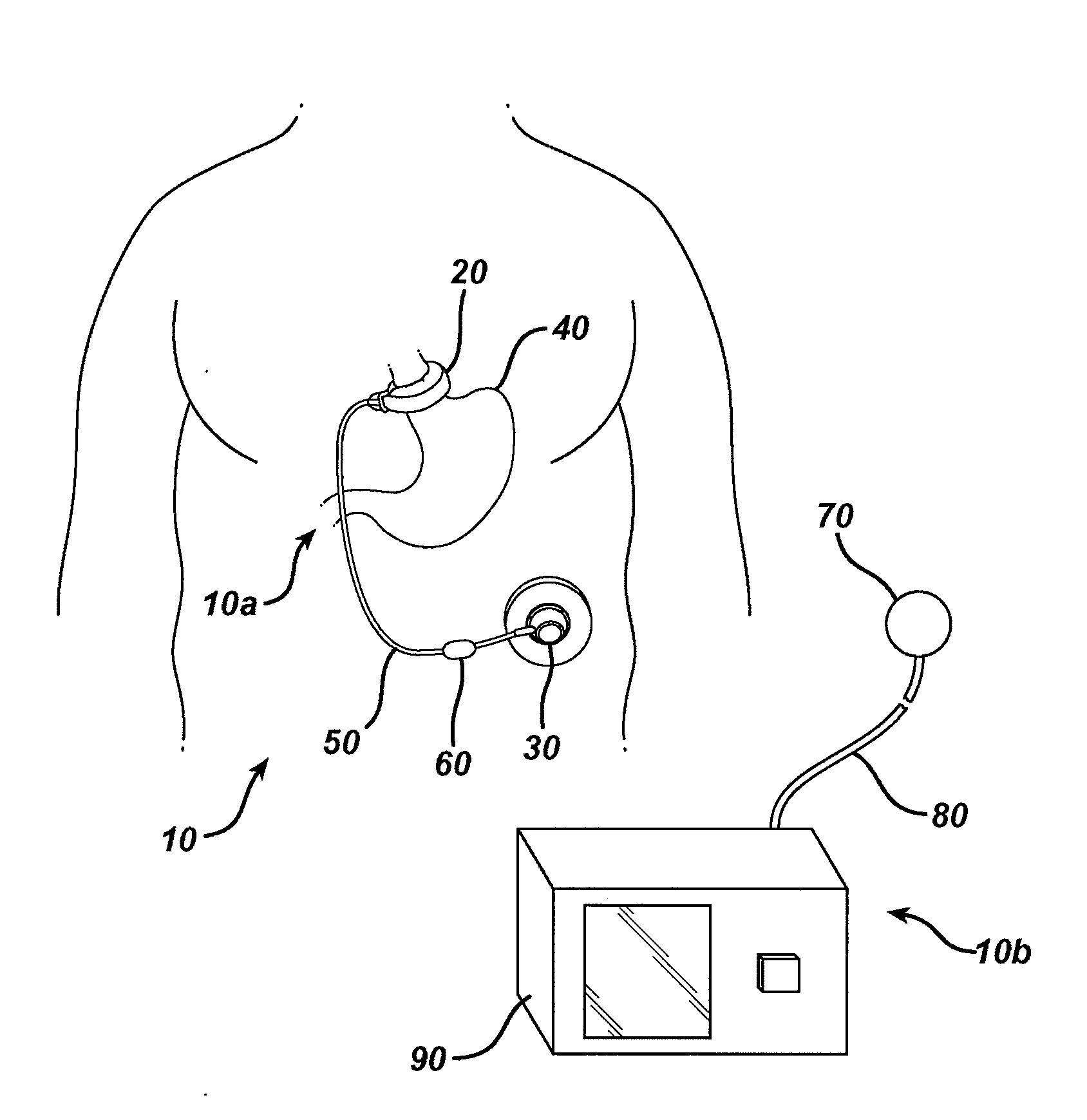 Methods and devices for predicting performance of a gastric restriction system