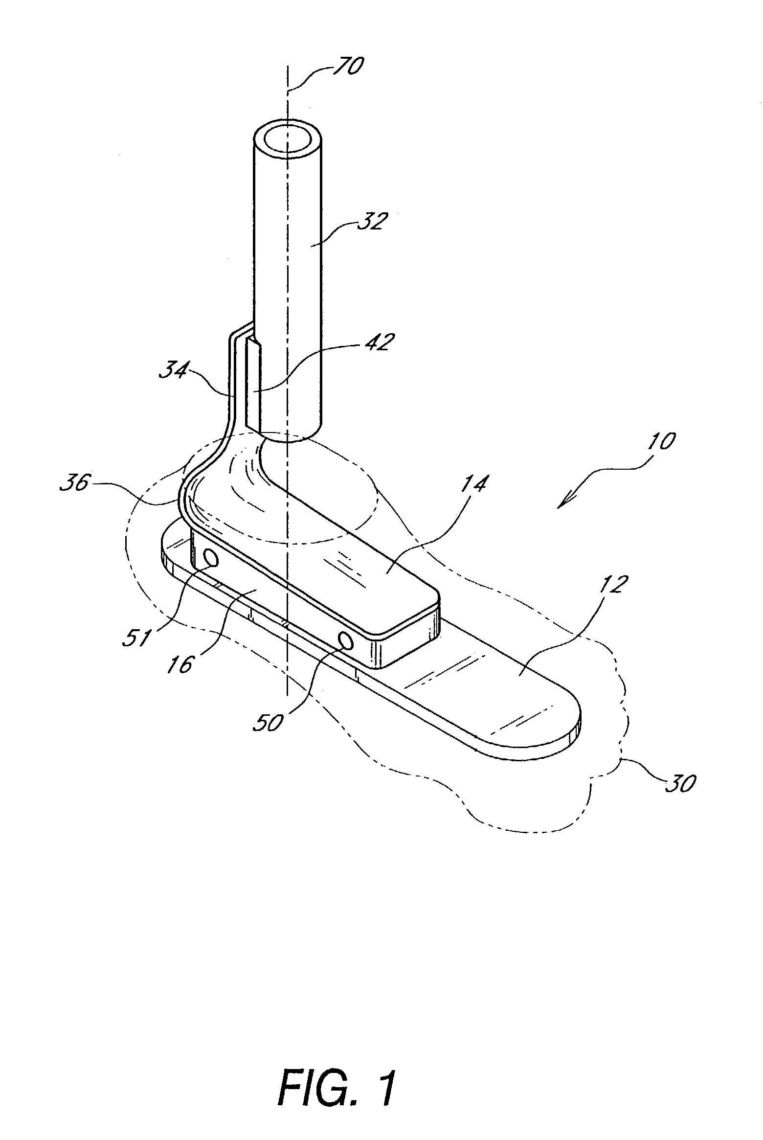 Foot prosthesis having cushioned ankle