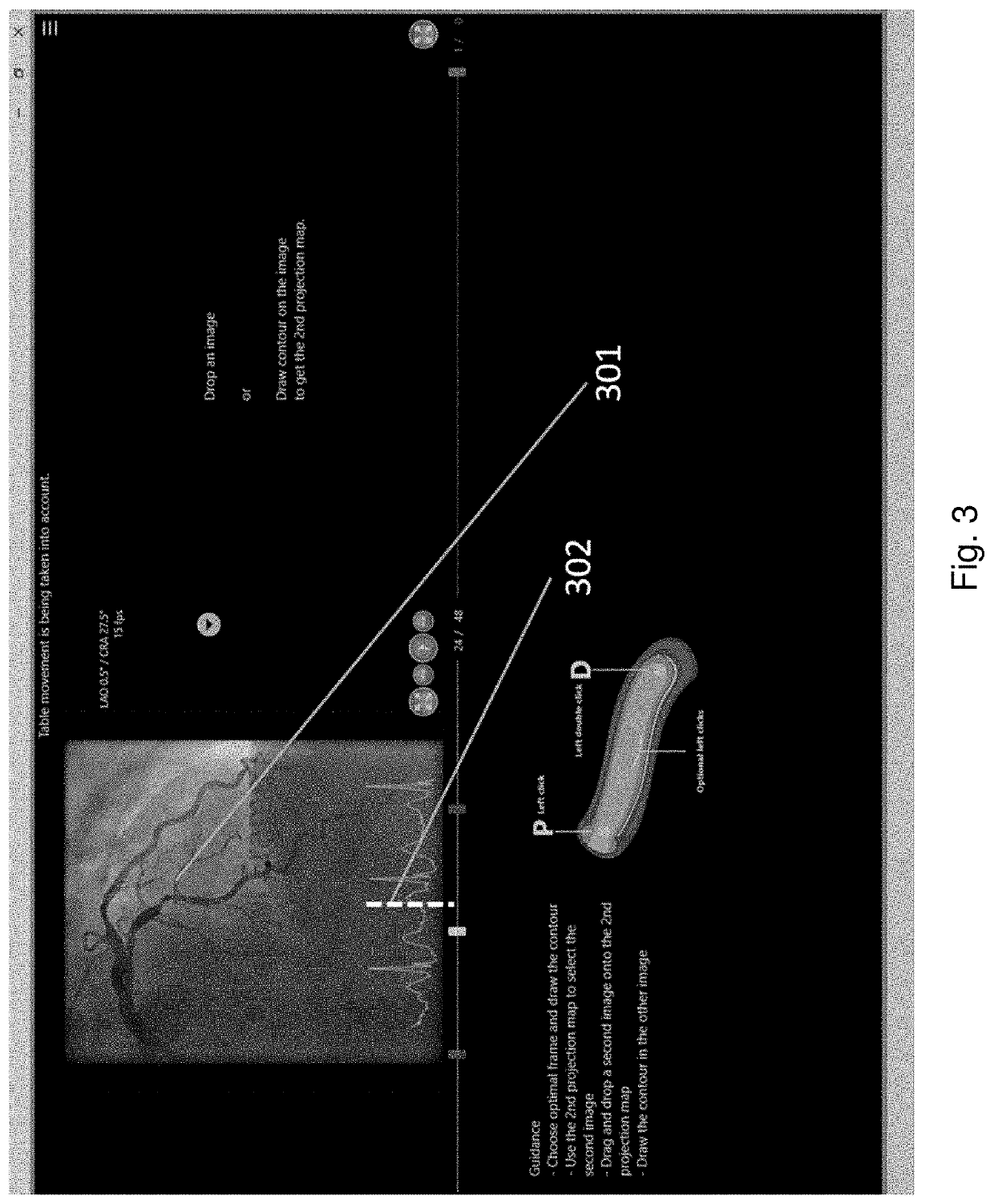 Method and system for calculating myocardial infarction likelihood based on lesion wall shear stress descriptors