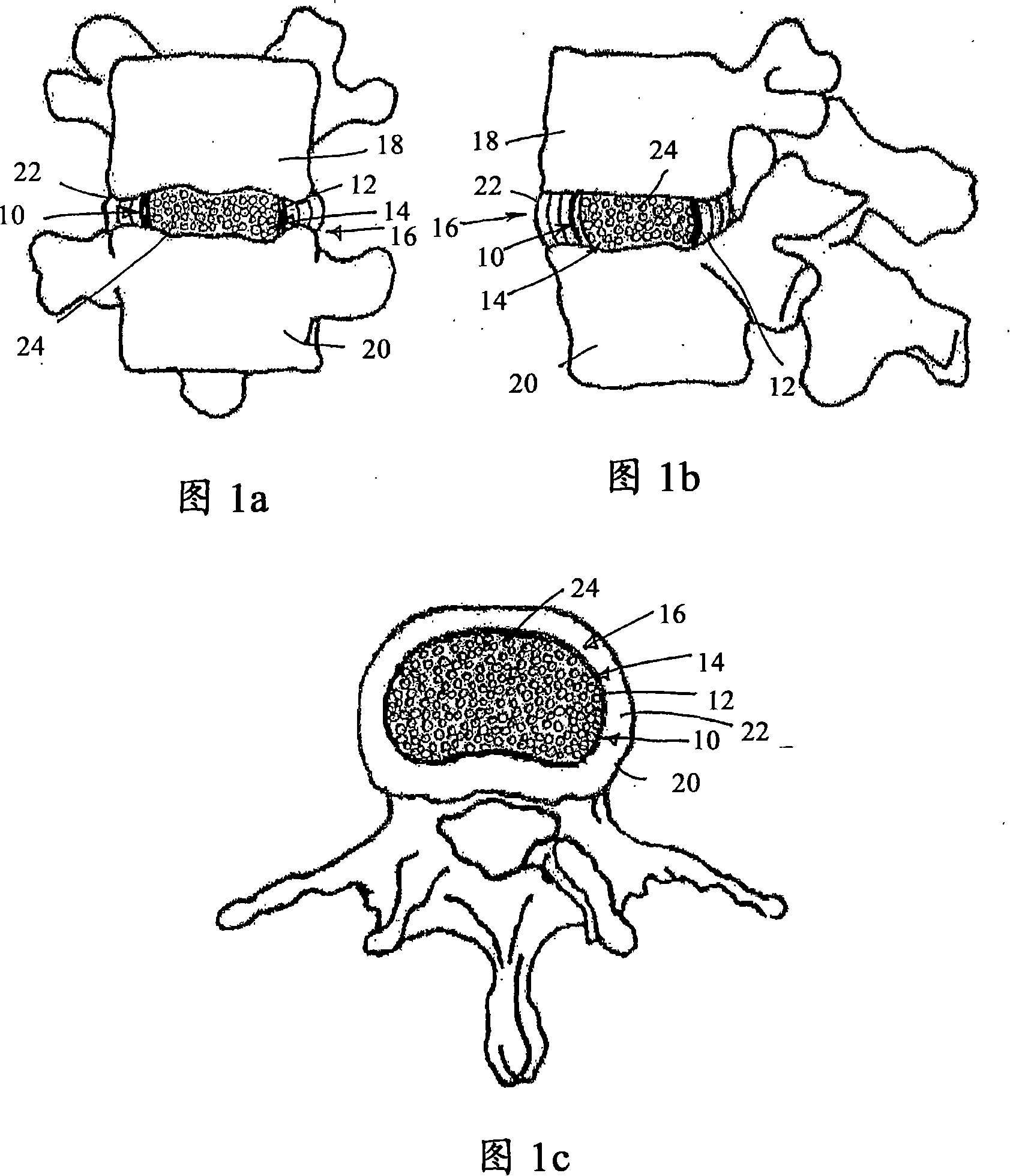 Intervertebral disc restoration