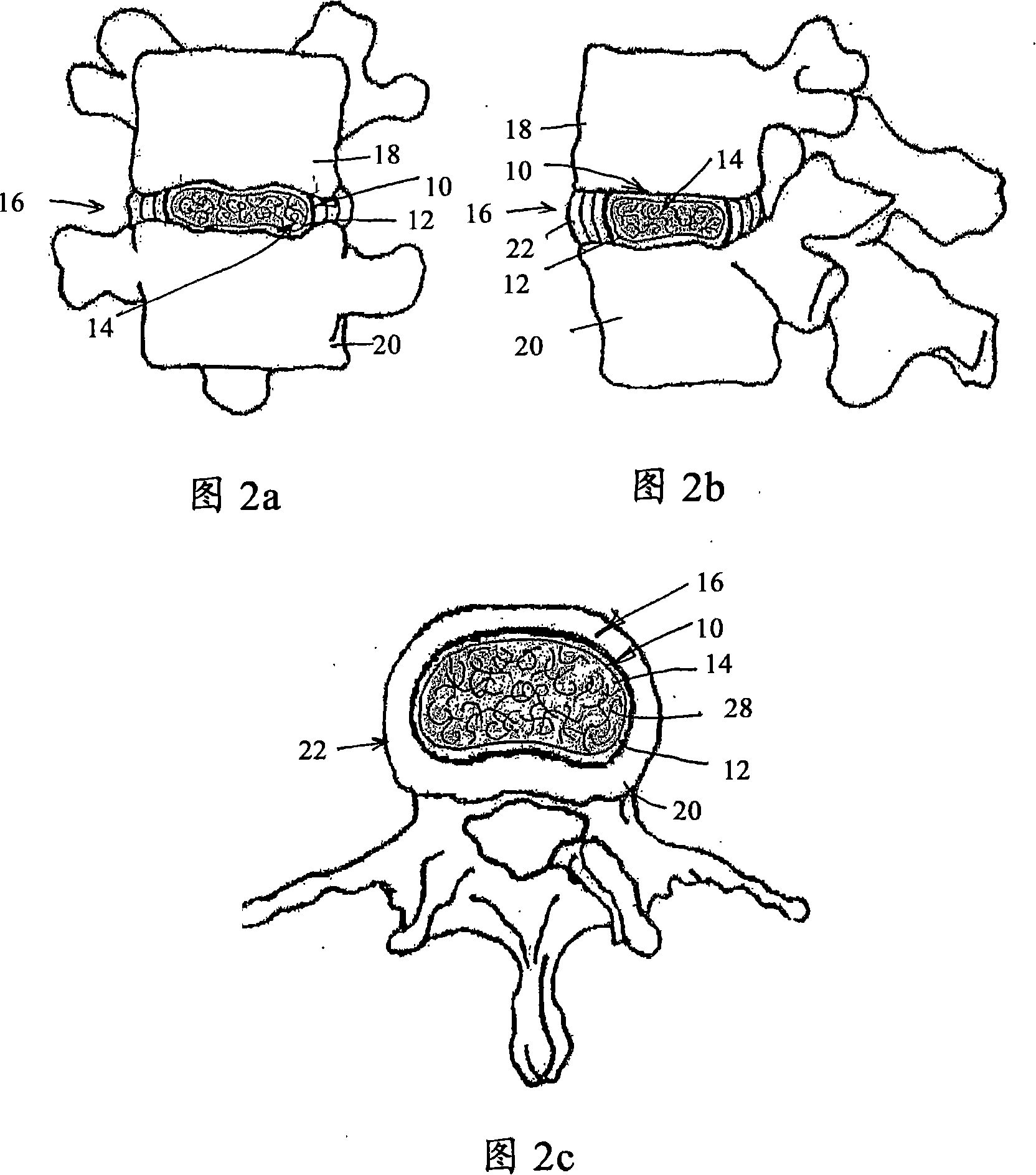 Intervertebral disc restoration