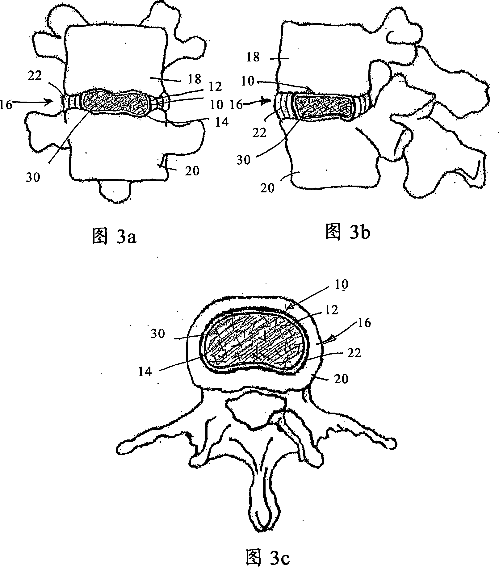 Intervertebral disc restoration