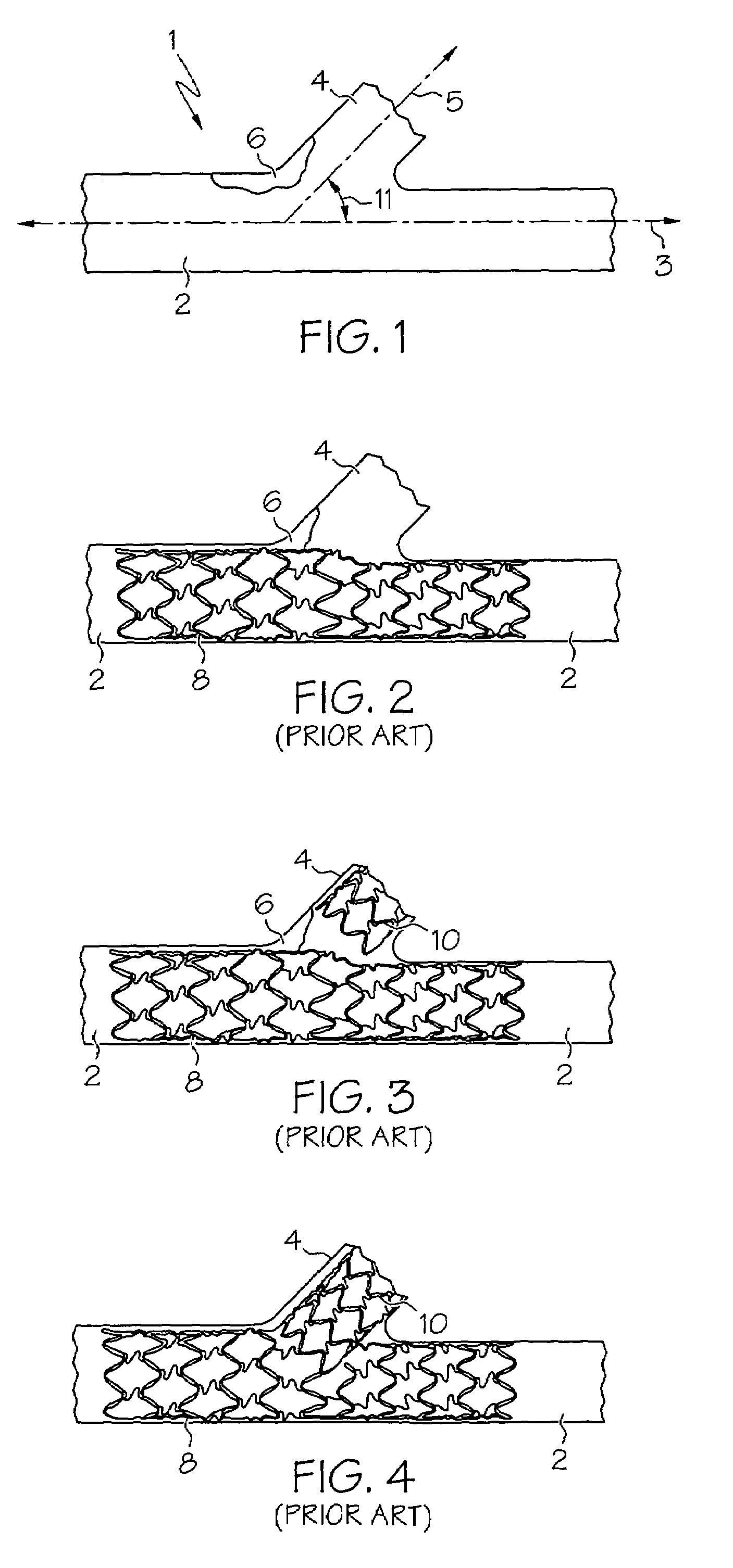 Stent with protruding branch portion for bifurcated vessels