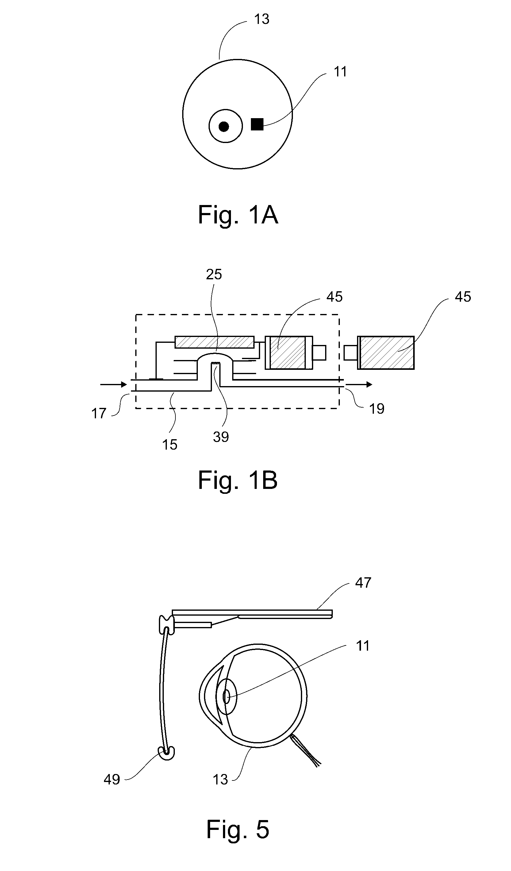 Implantable ocular microapparatus to ameliorate glaucoma or an ocular overpressure causing disease