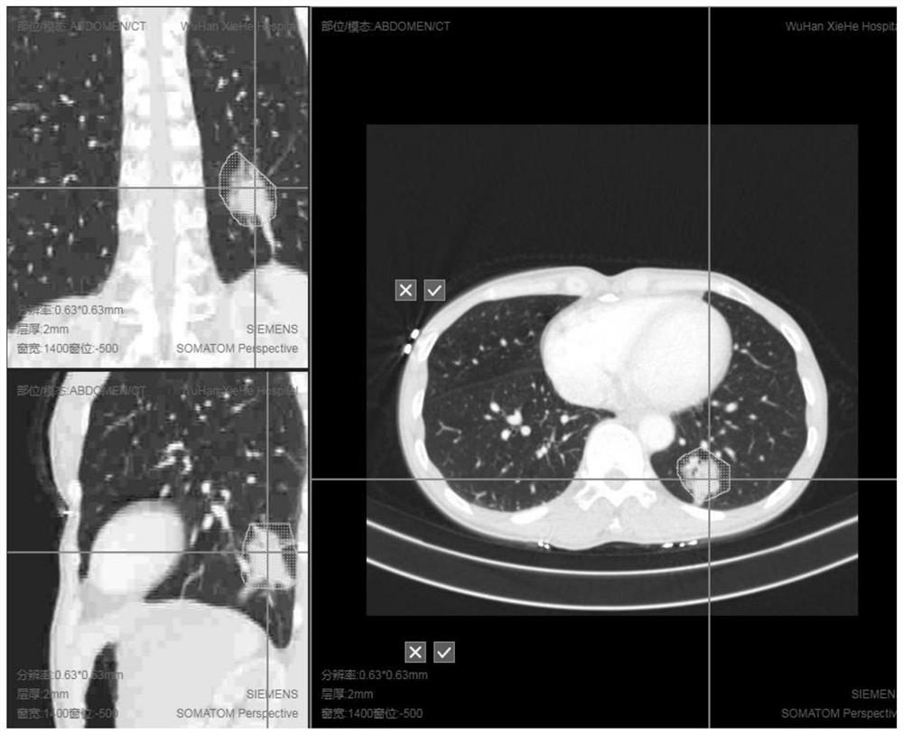 Pulmonary nodule interactive segmentation method based on medical image