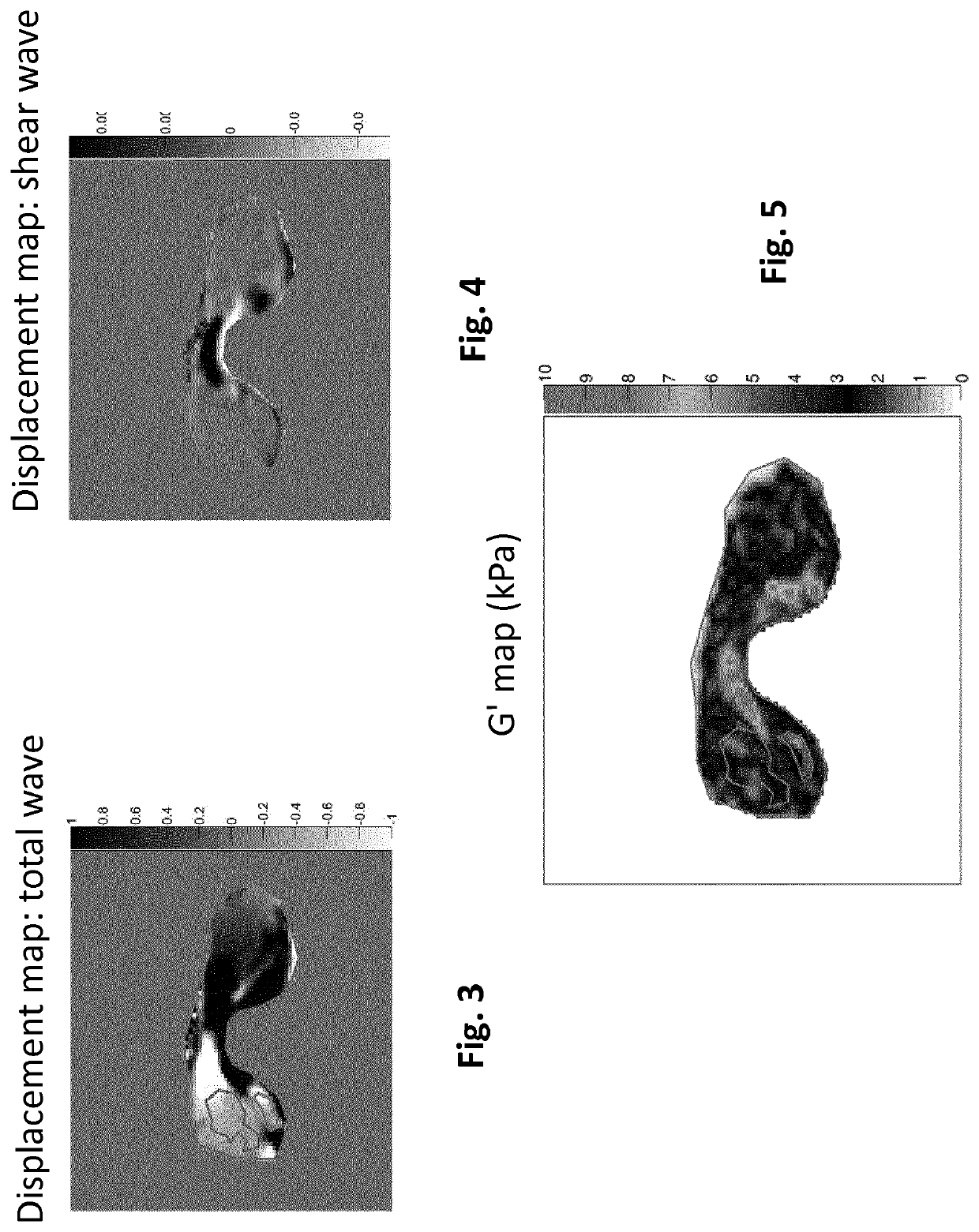 Method for predicting obesity related disease using images of the subcutaneous adipose tissue or the epididymal adipose tissue