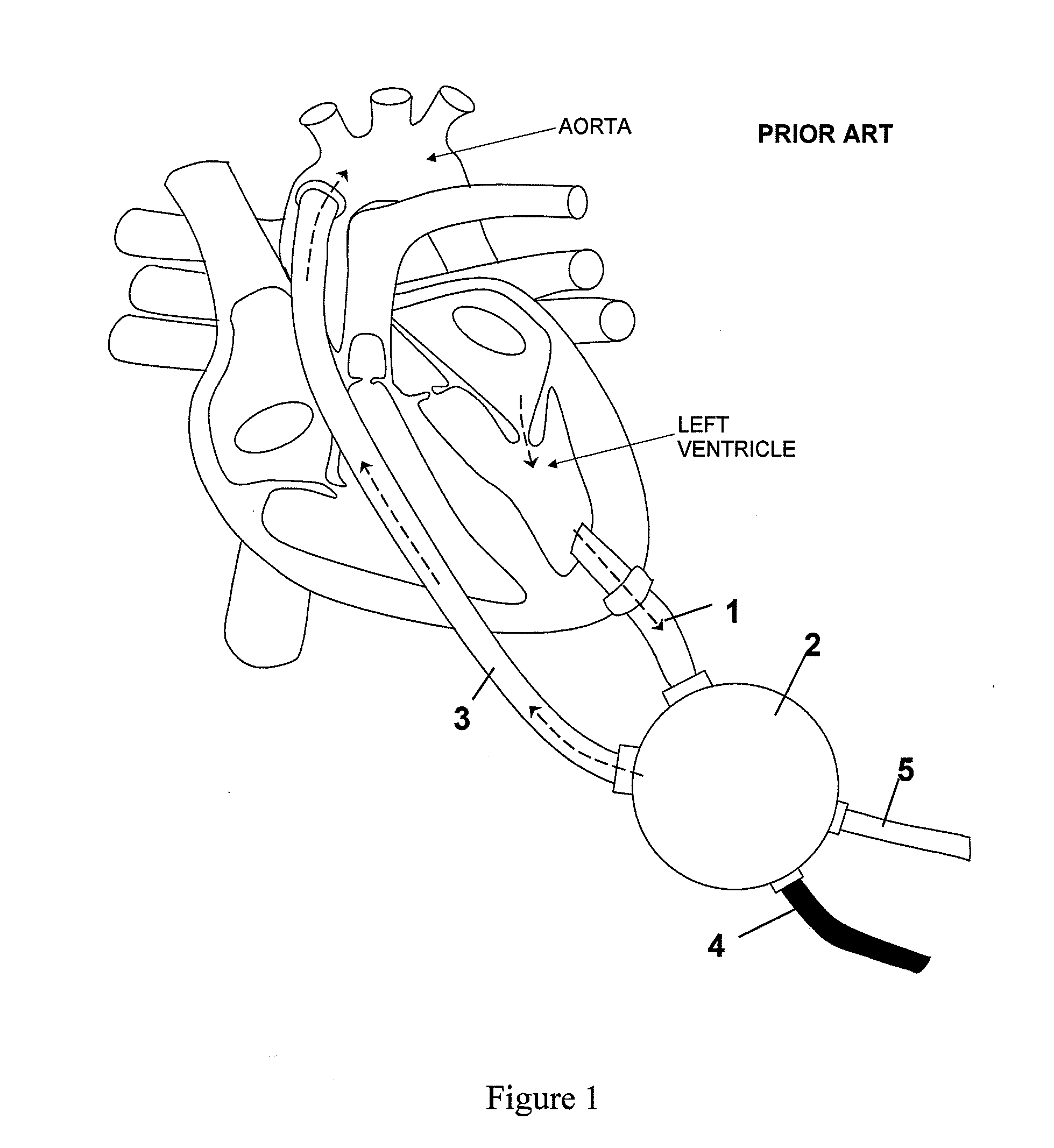 Heart assist device