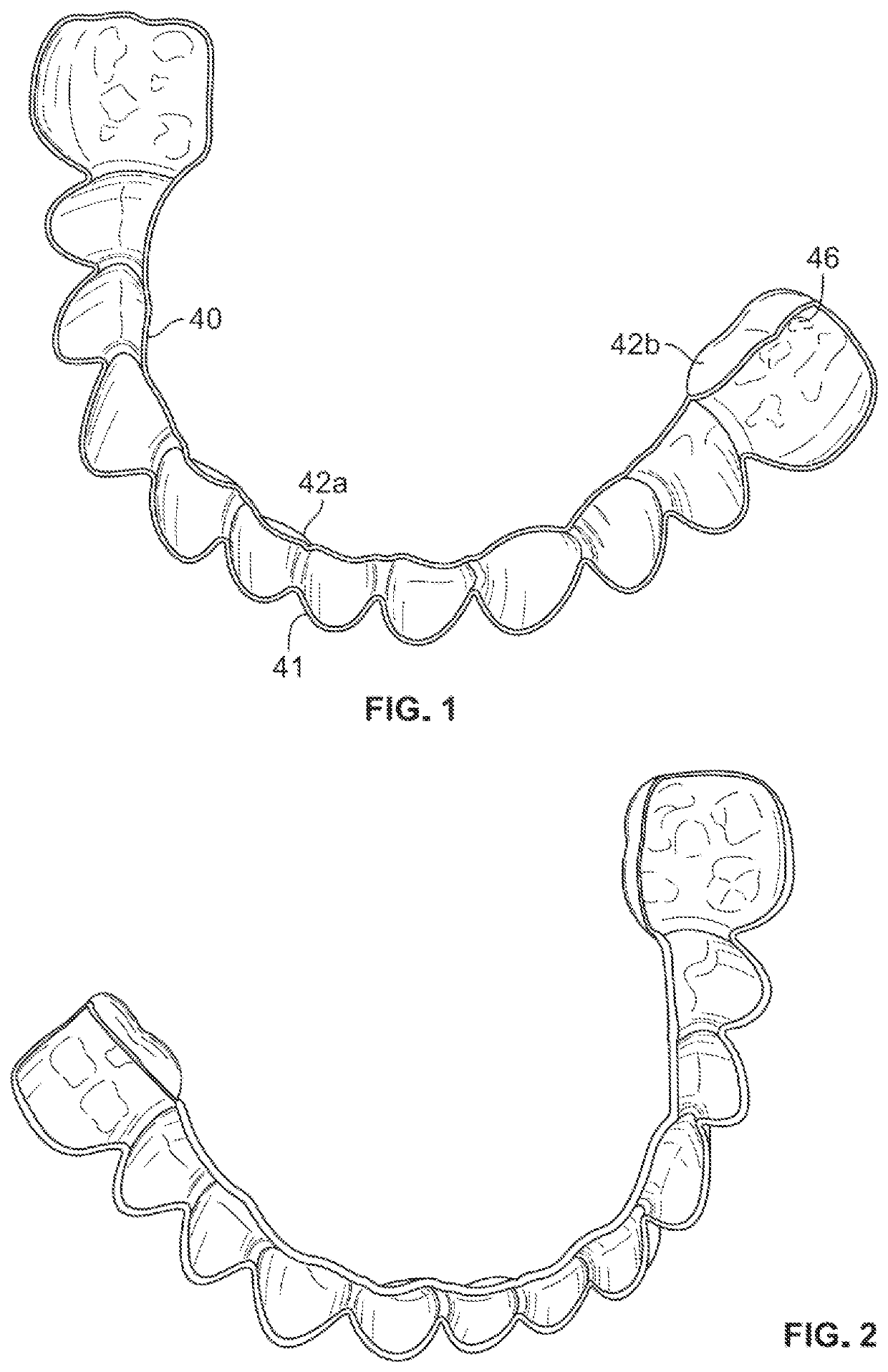 Customized dental veneers