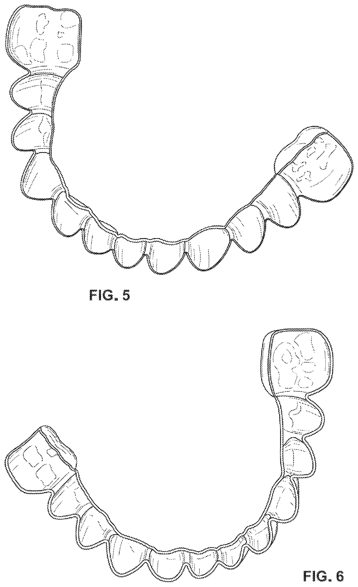 Customized dental veneers