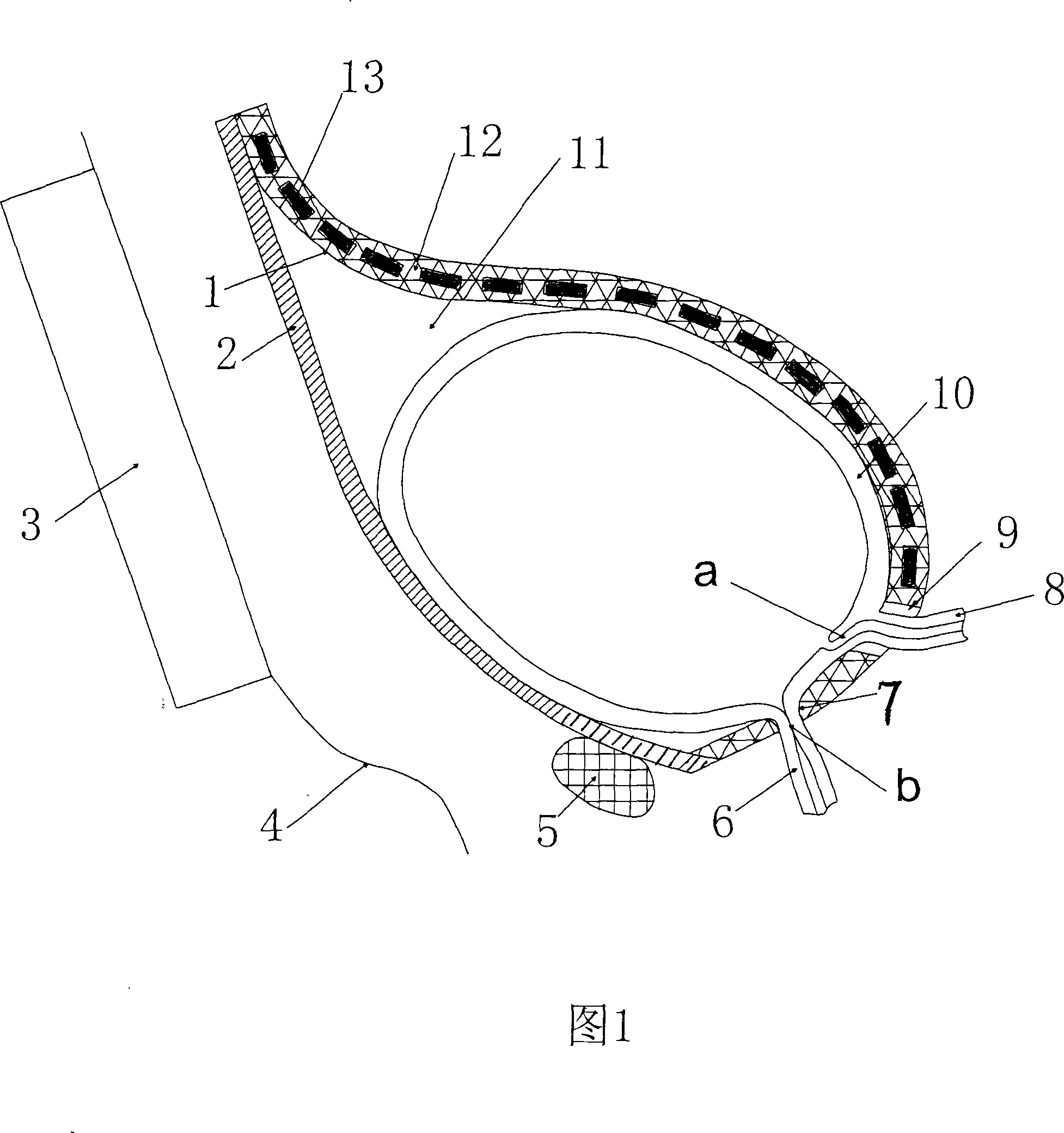 Urinary bladder power pump driven by external electromagnetism