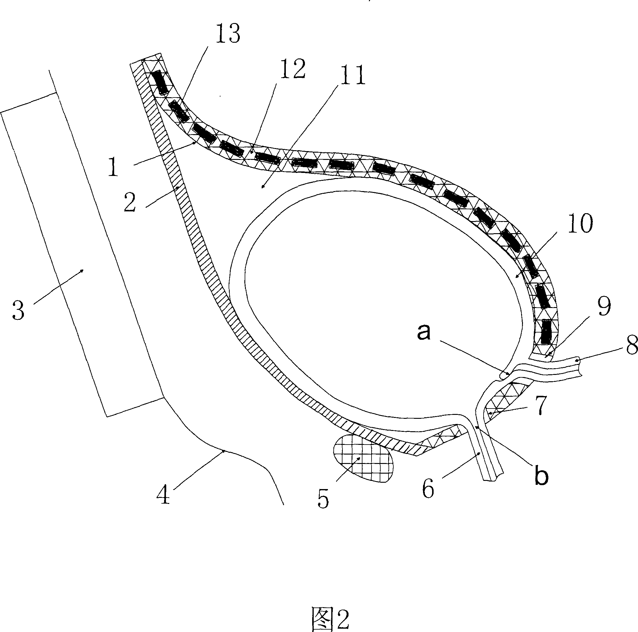 Urinary bladder power pump driven by external electromagnetism