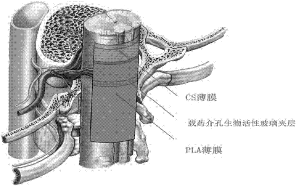 Sandwich type composite membrane stent