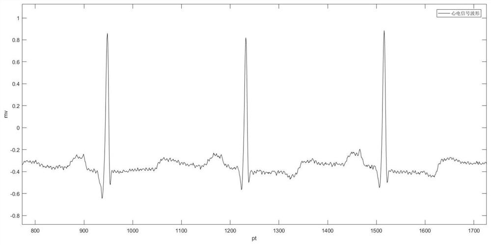 A method and system for extracting and classifying ECG signal features