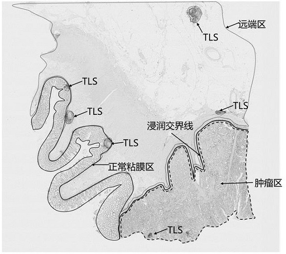 Marker and model construction method and system for prognosis prediction of colon cancer