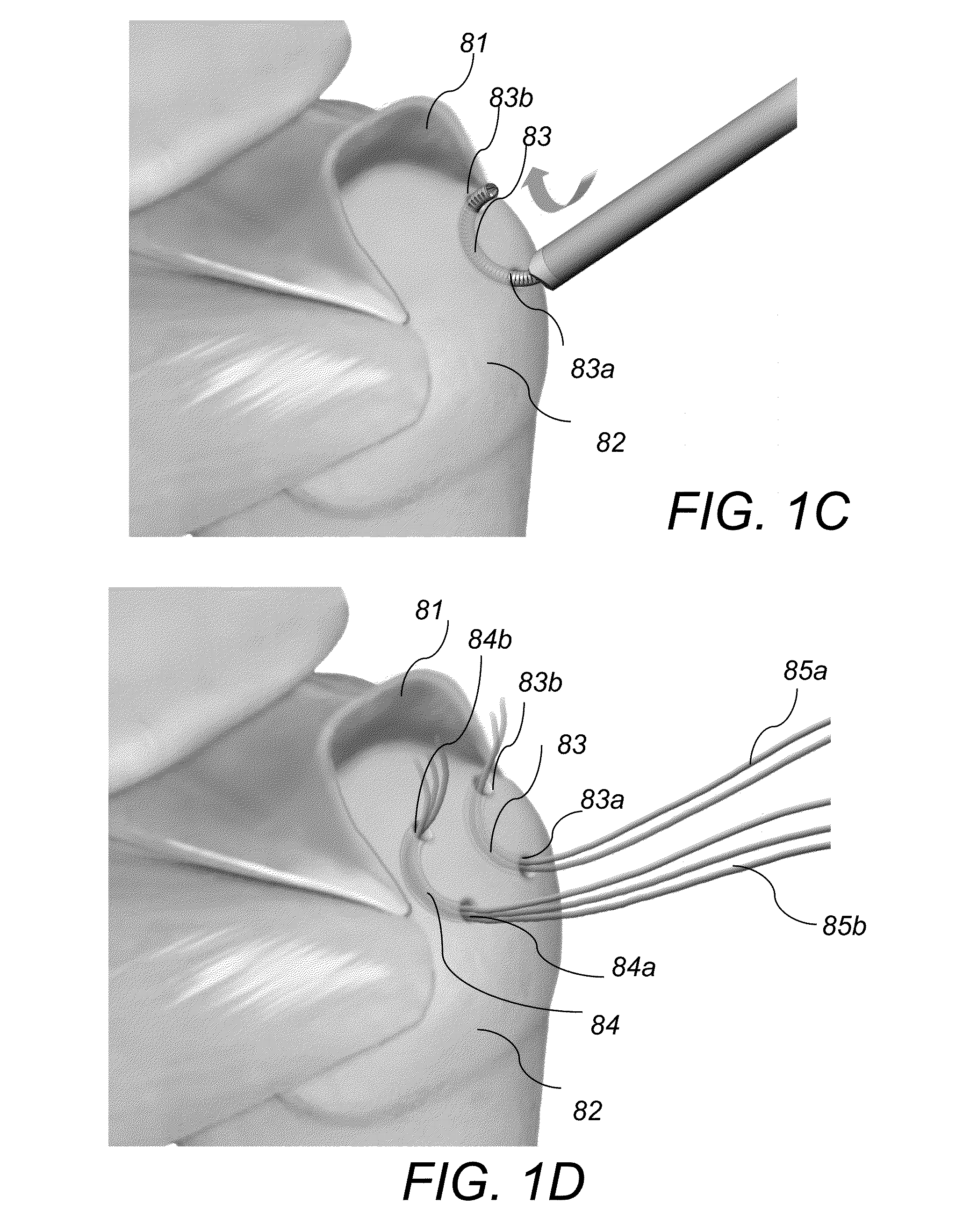 System and method for forming a curved tunnel in bone