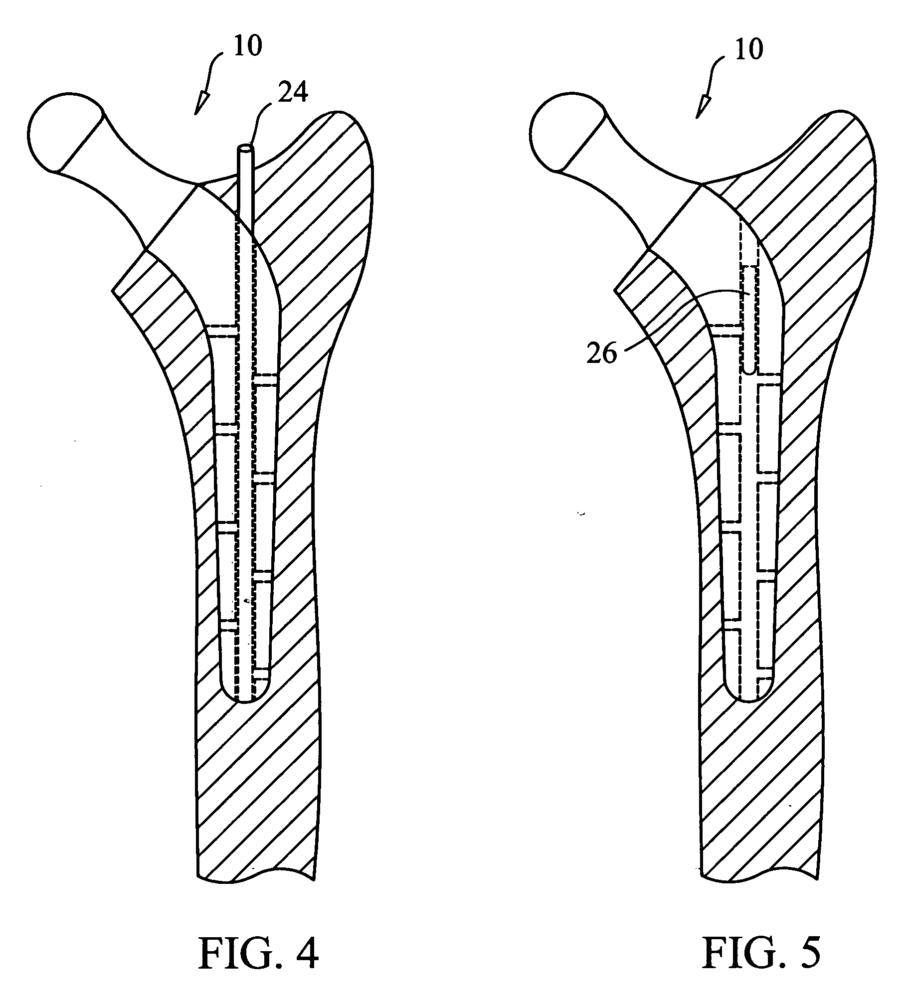 Orthopedic system for total hip replacement surgery