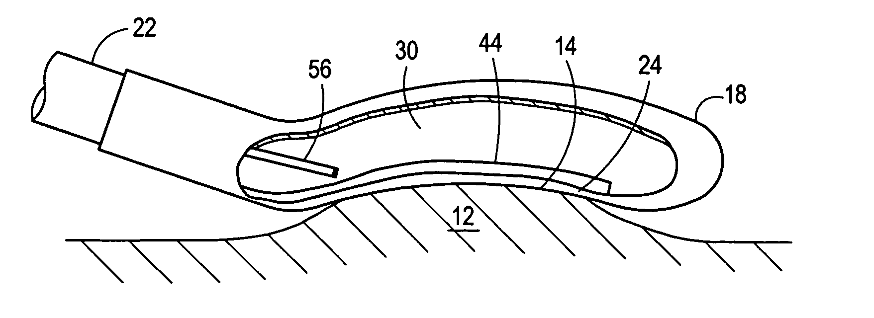 Reshapeable tip for a cryoprobe