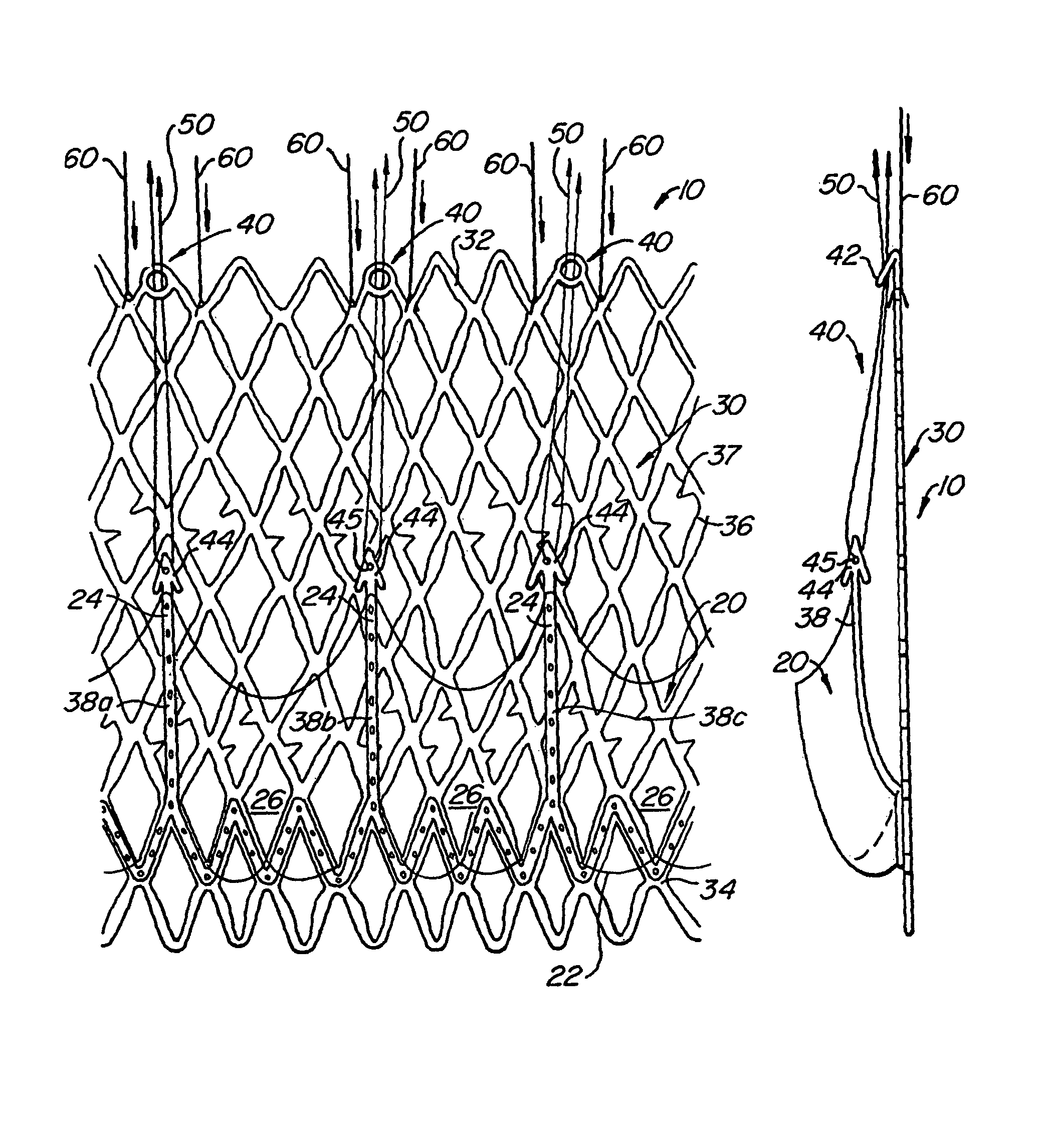 Replacement valve and anchor