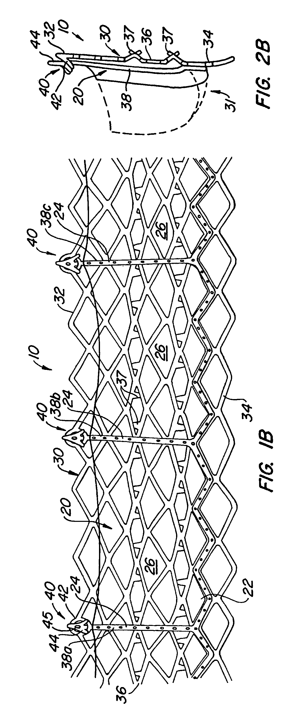 Replacement valve and anchor