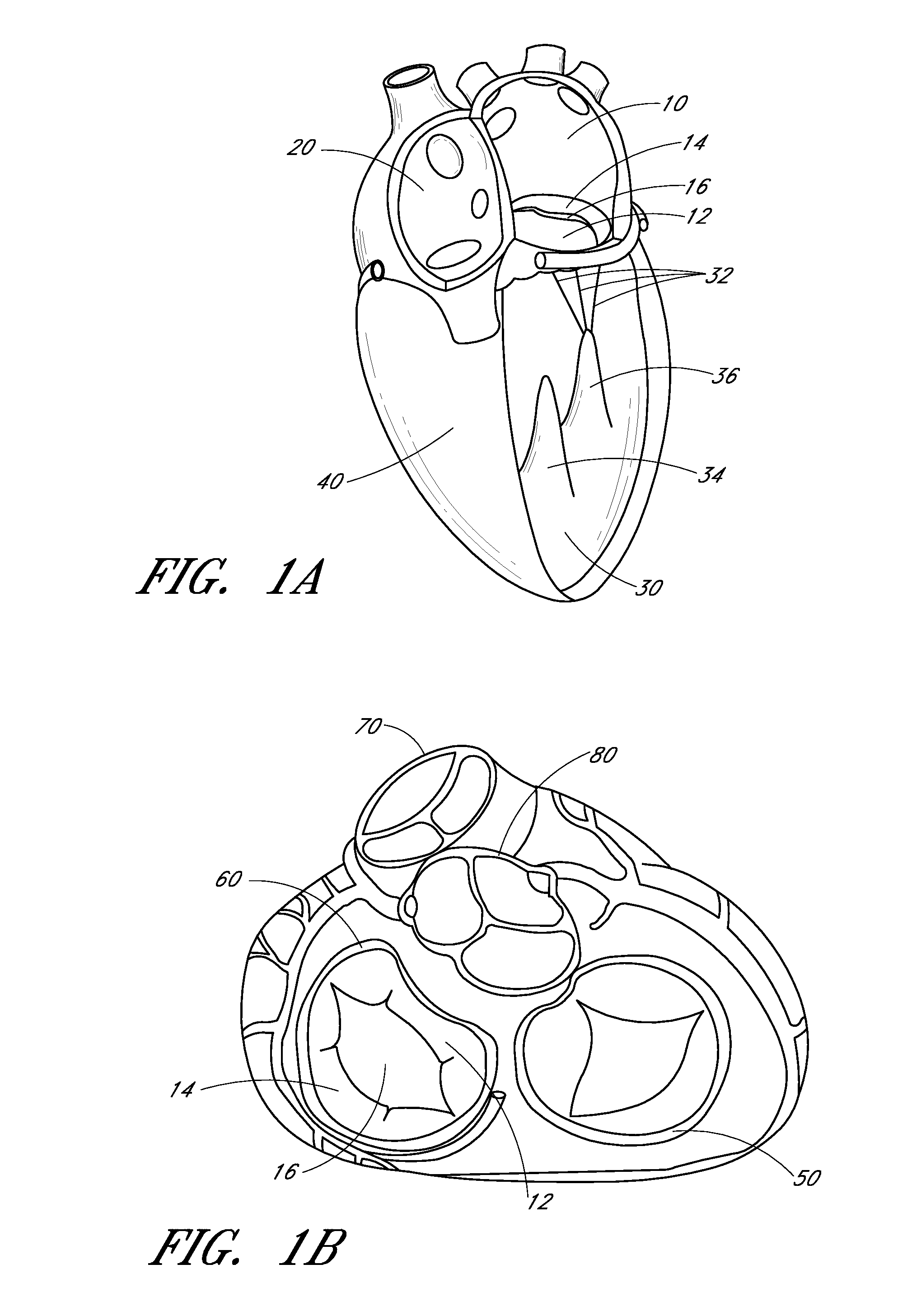 Device, system, and method for transcatheter treatment of valve regurgitation