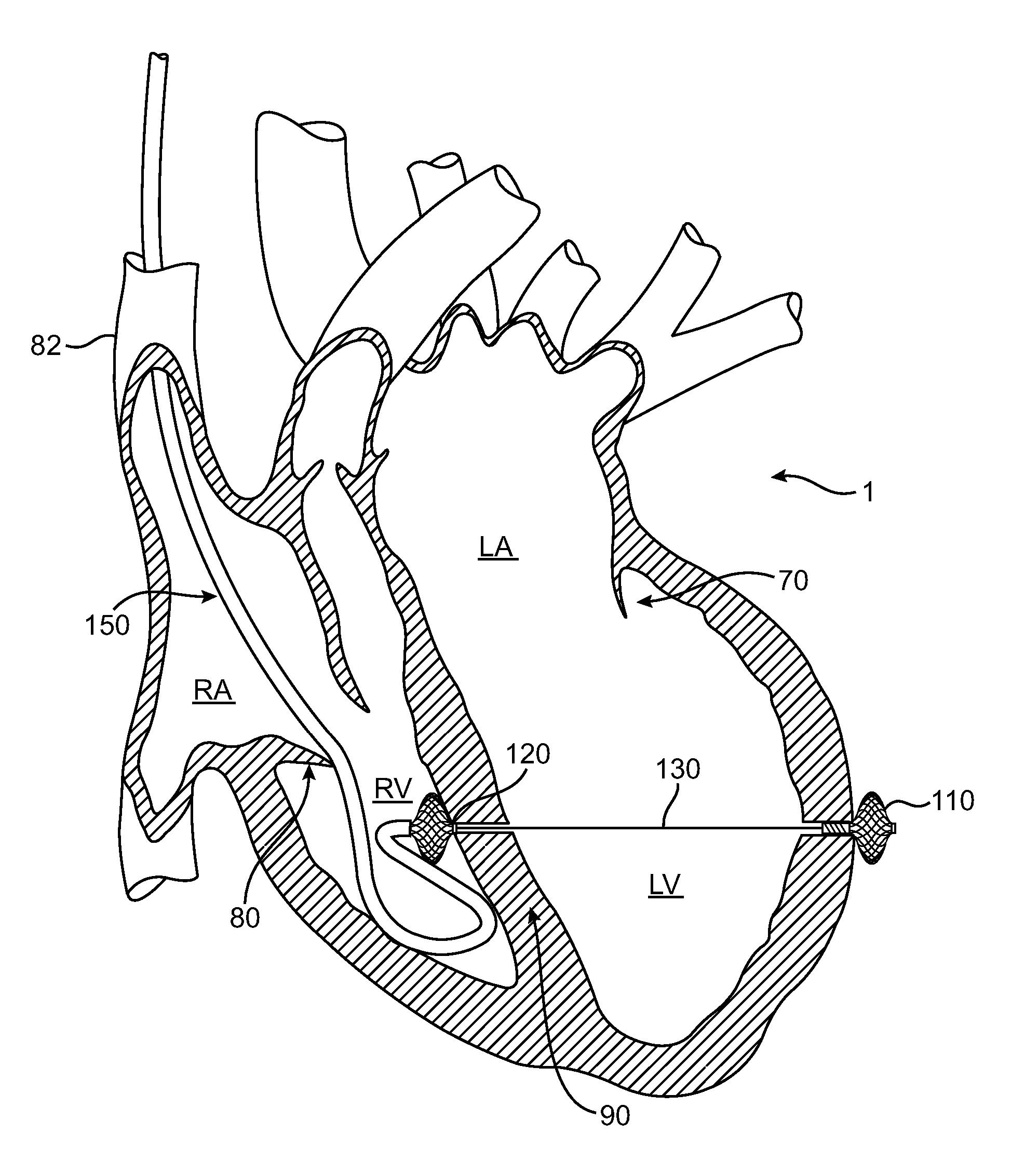 System for Treating Mitral Valve Regurgitation