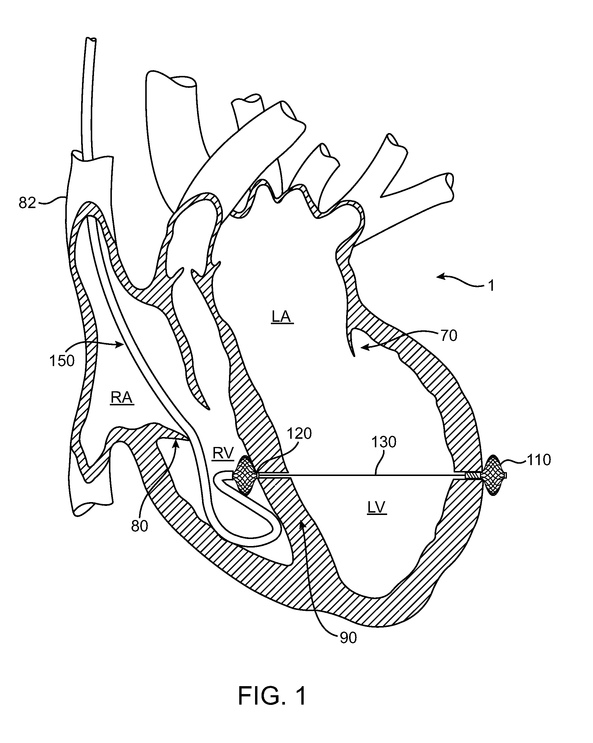 System for Treating Mitral Valve Regurgitation