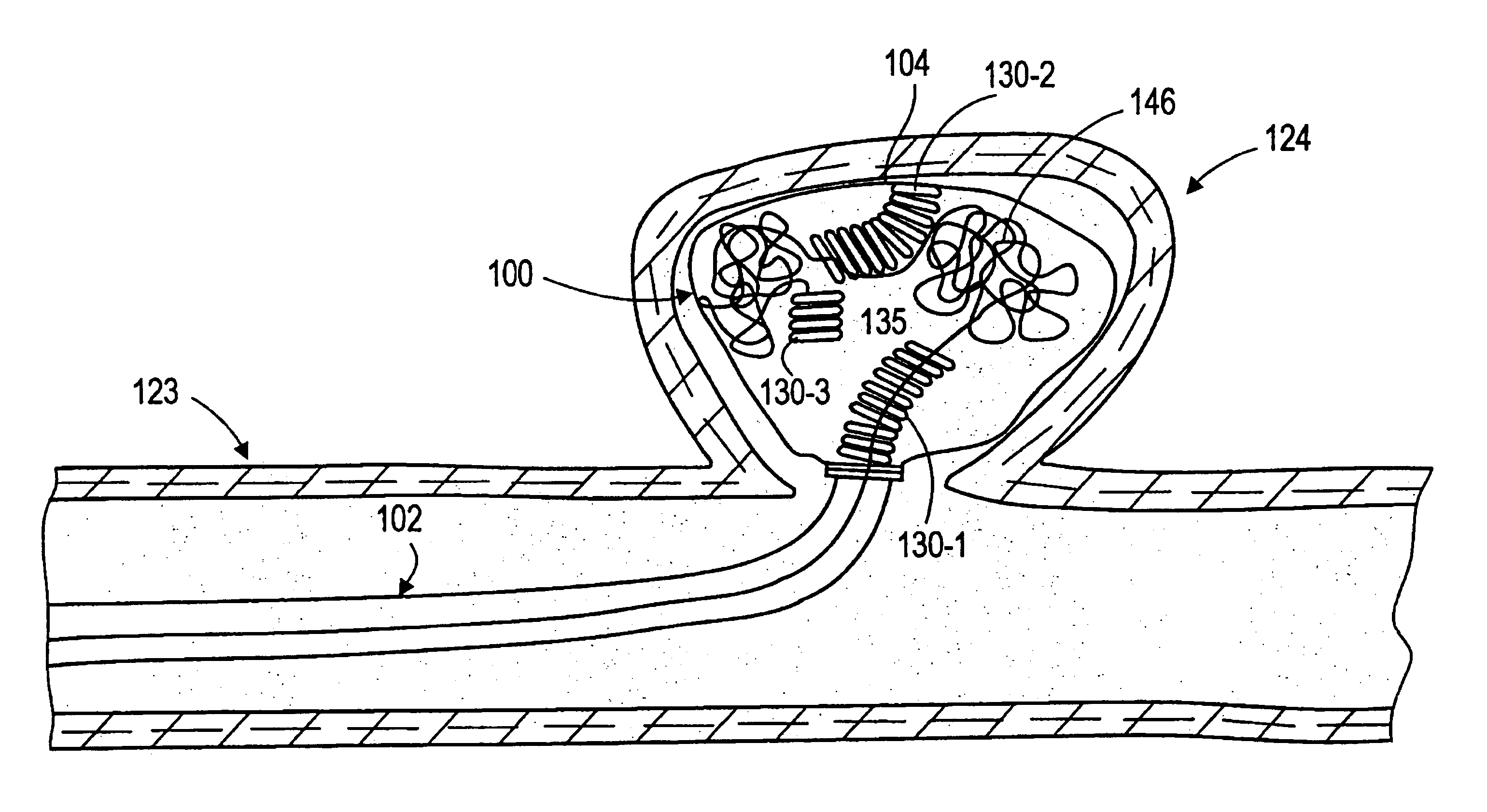 Aneurysm liner with multi-segment extender