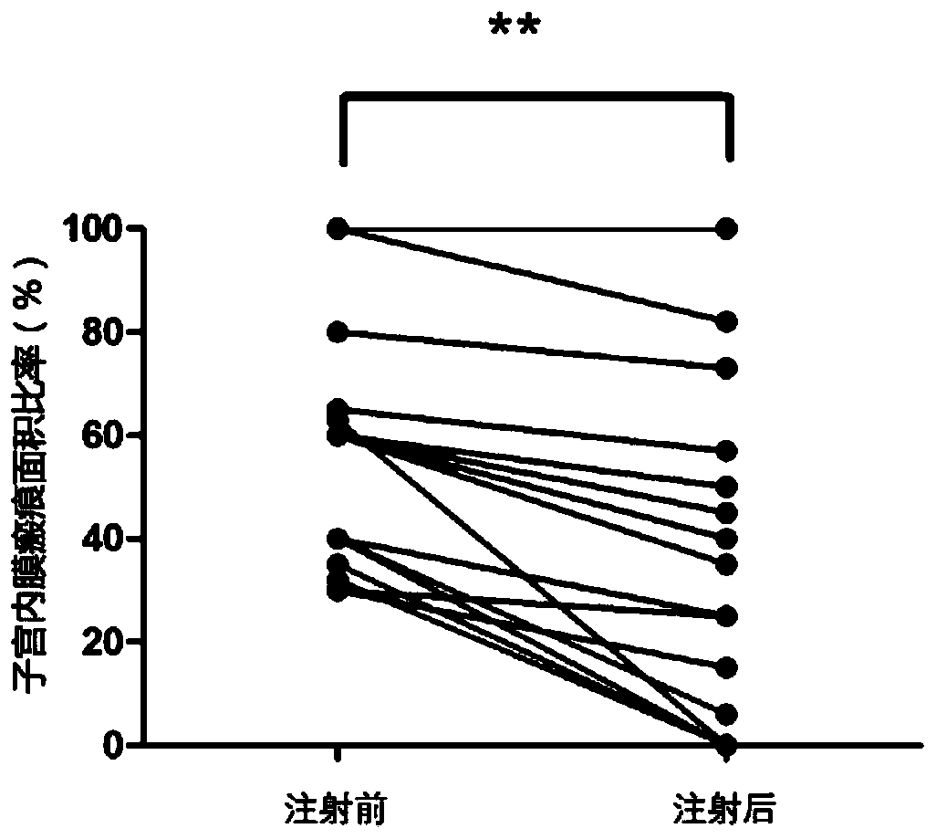 Targeted growth factor for promoting scar endometrium reconstruction of infertile women and application of targeted growth factor