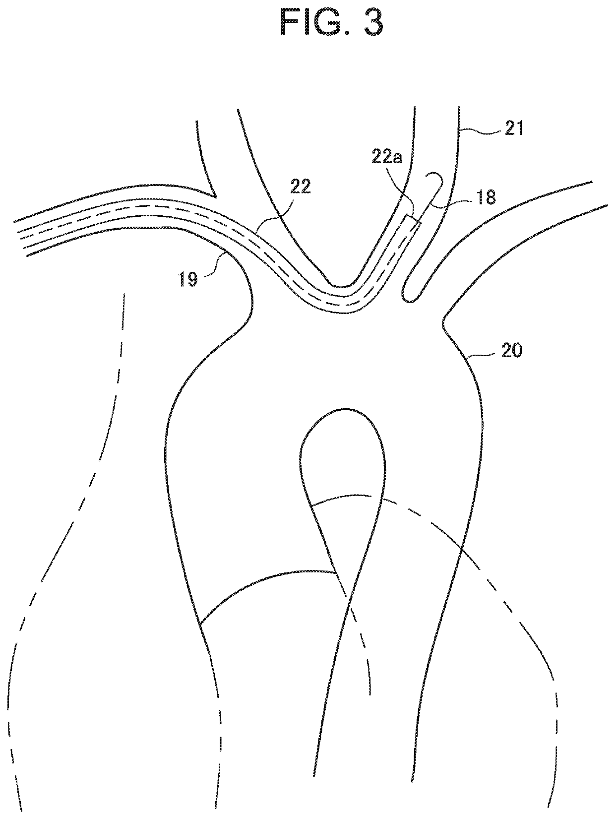 Emboli capture device