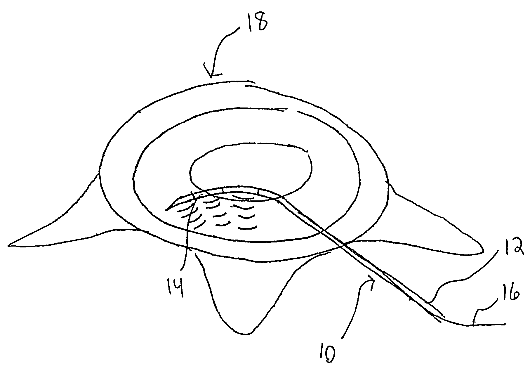 Ultrasound device for treatment of intervertebral disc