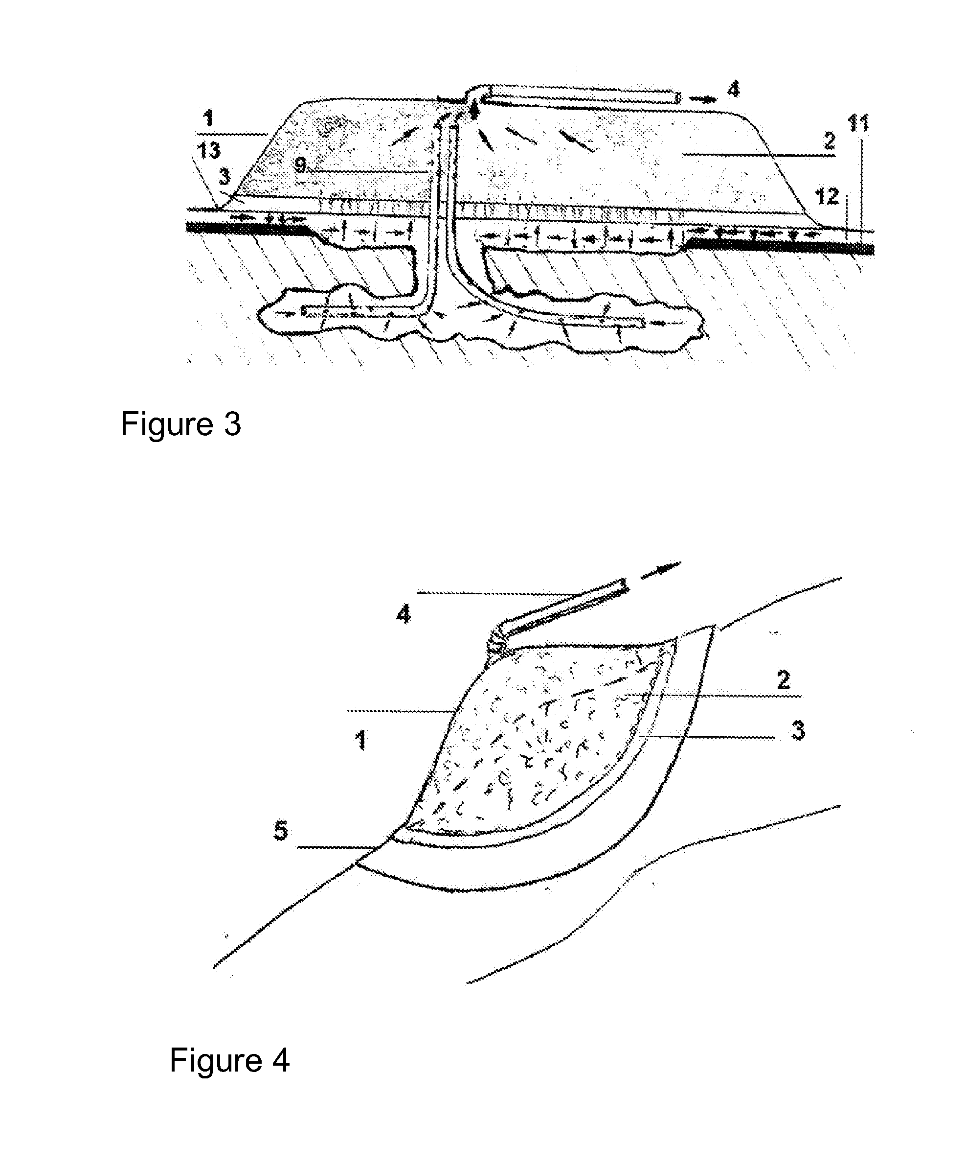 Perfecting of the improved vacuum dressing and the use thereof in vacuum-assisted therapy