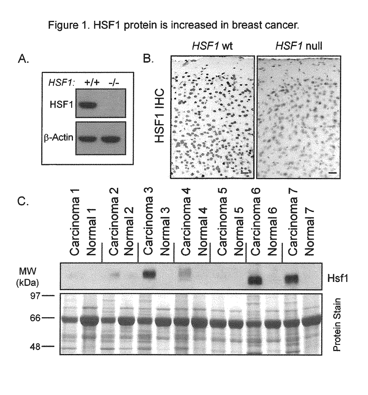 HSF1 as a marker in tumor prognosis and treatment