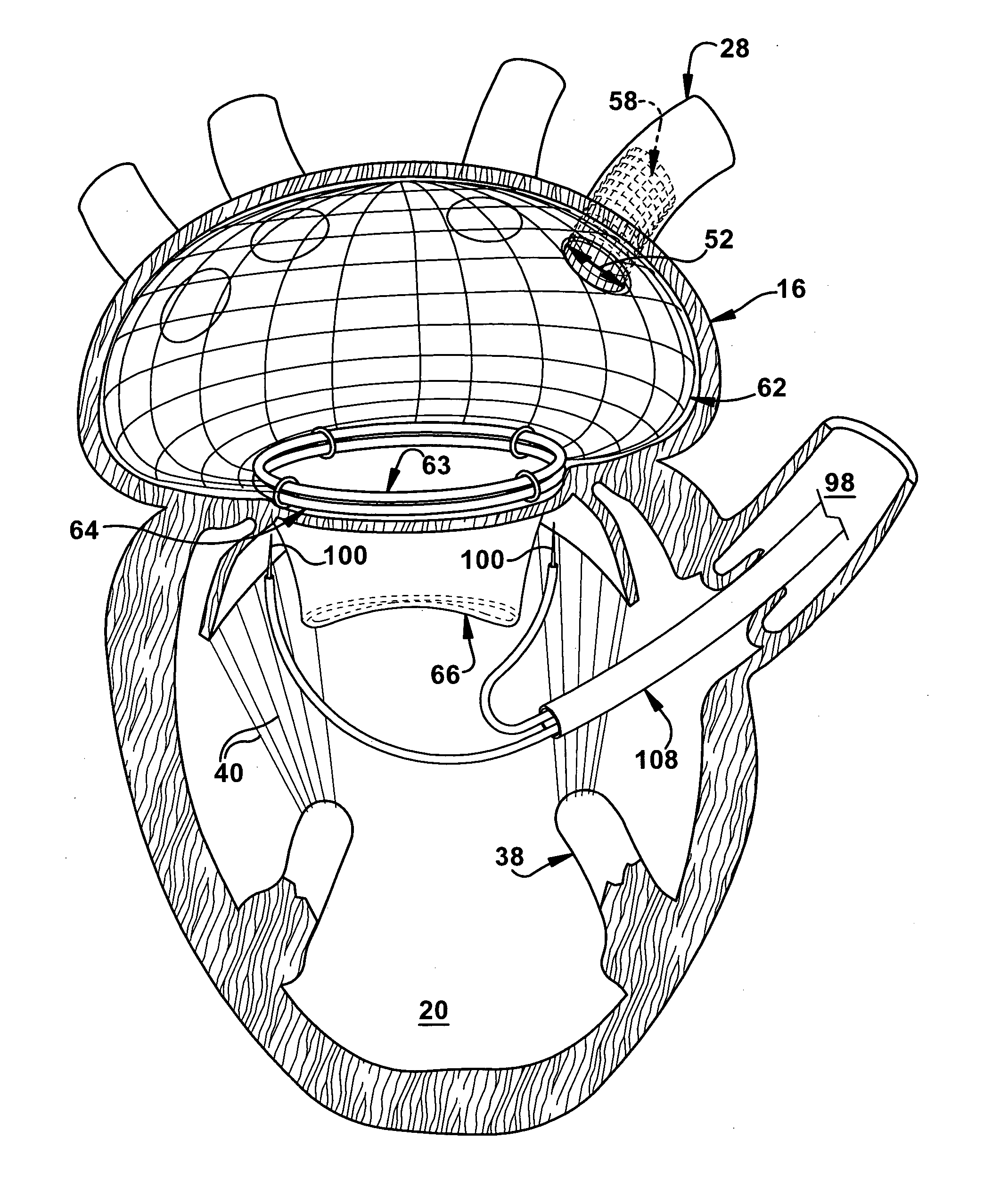 Percutaneous atrioventricular valve and method of use