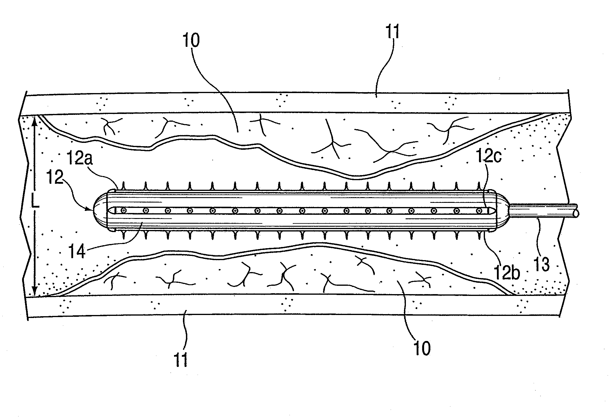 Pre-angioplasty serration of atherosclerotic plaque enabling low-pressure balloon angioplasty and avoidance of stenting