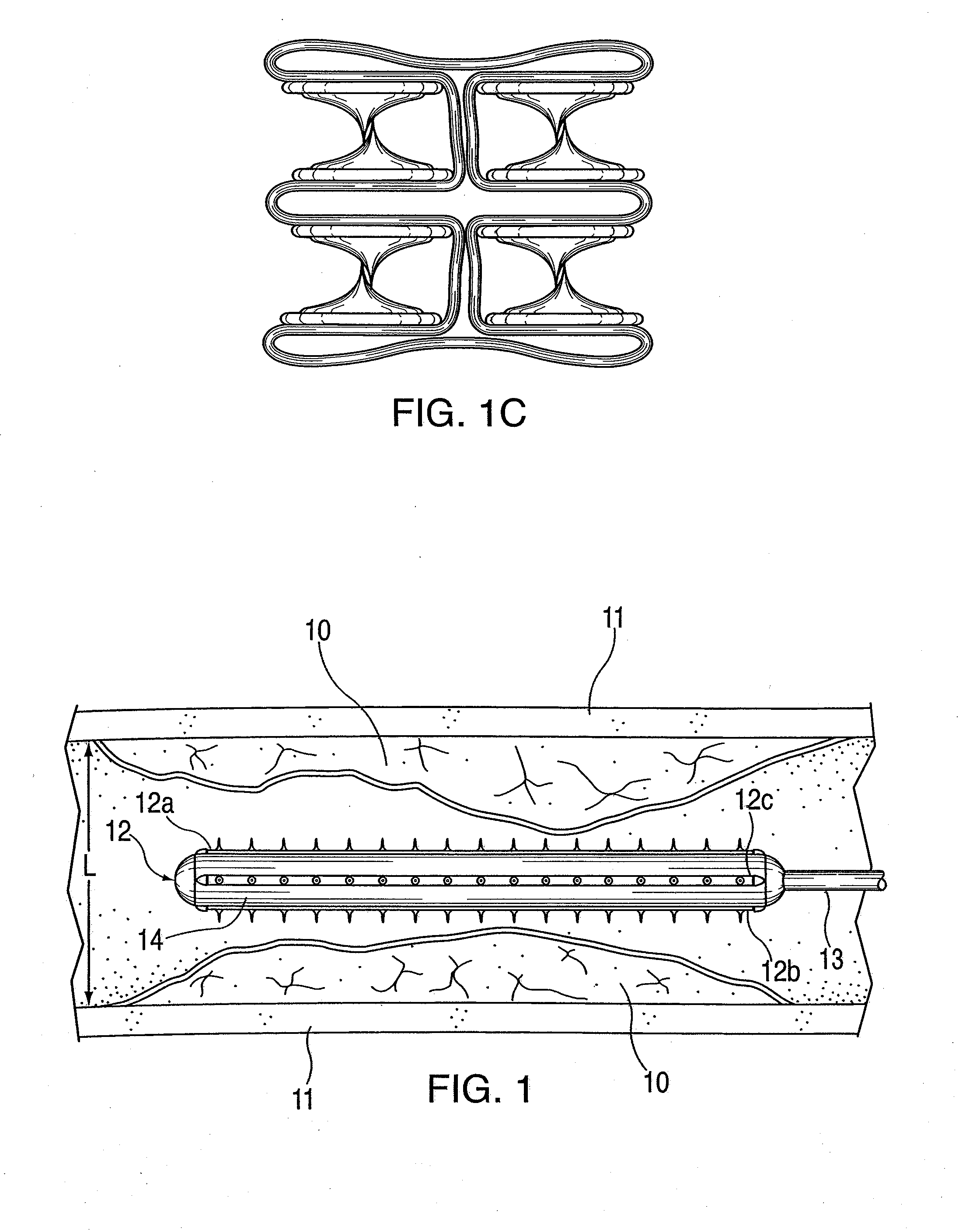 Pre-angioplasty serration of atherosclerotic plaque enabling low-pressure balloon angioplasty and avoidance of stenting