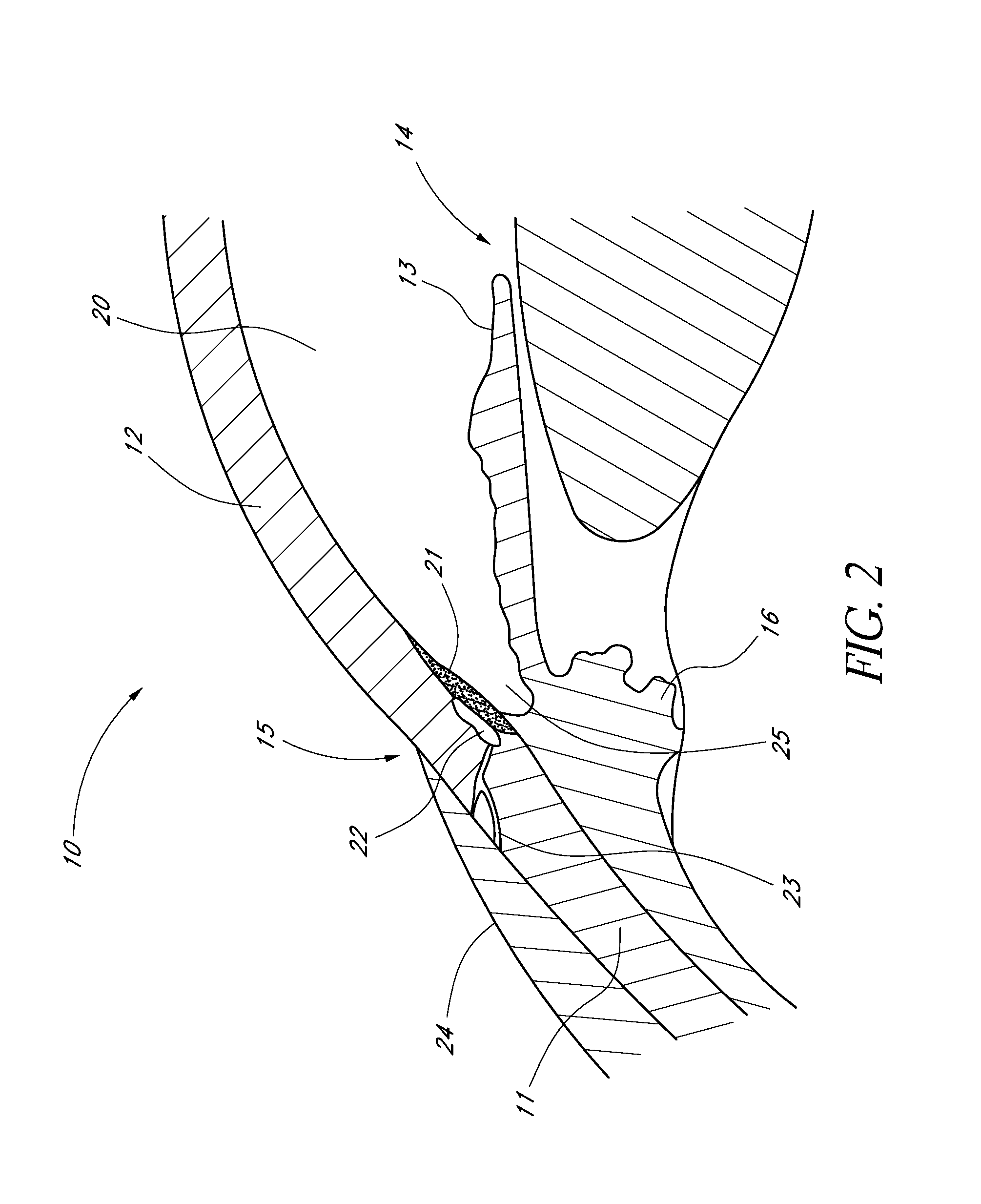 Glaucoma stent and methods thereof for glaucoma treatment