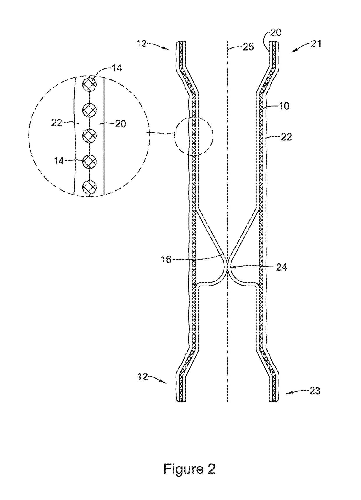 Esophageal stent including a valve member