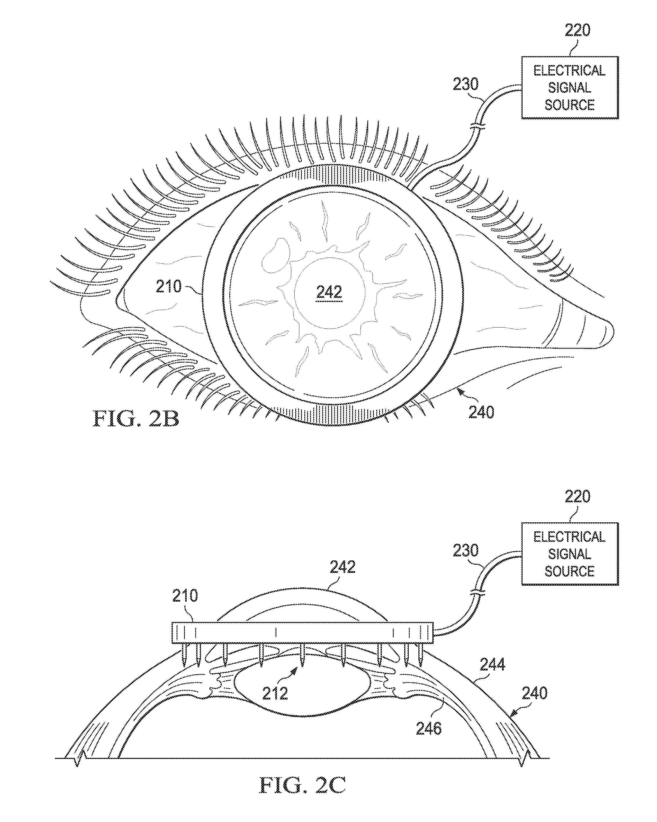 System and procedure for enhancing ocular drainage