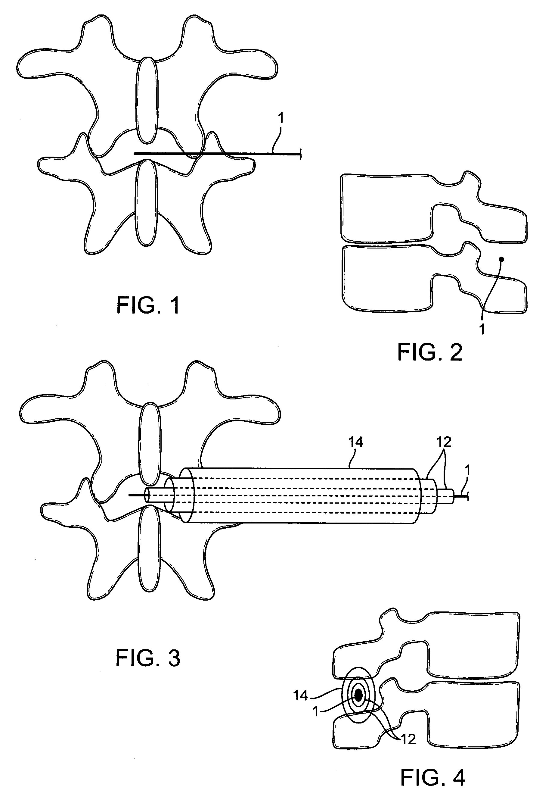 Implant device and method for interspinous distraction