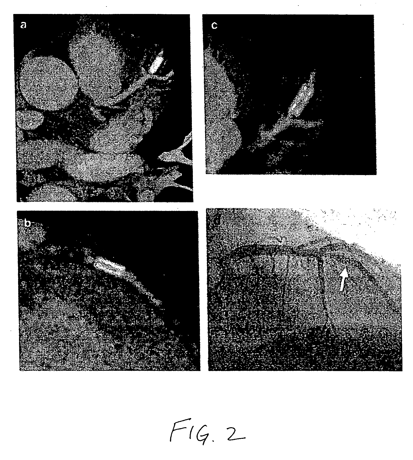 Medical devices having a temporary radiopaque coating