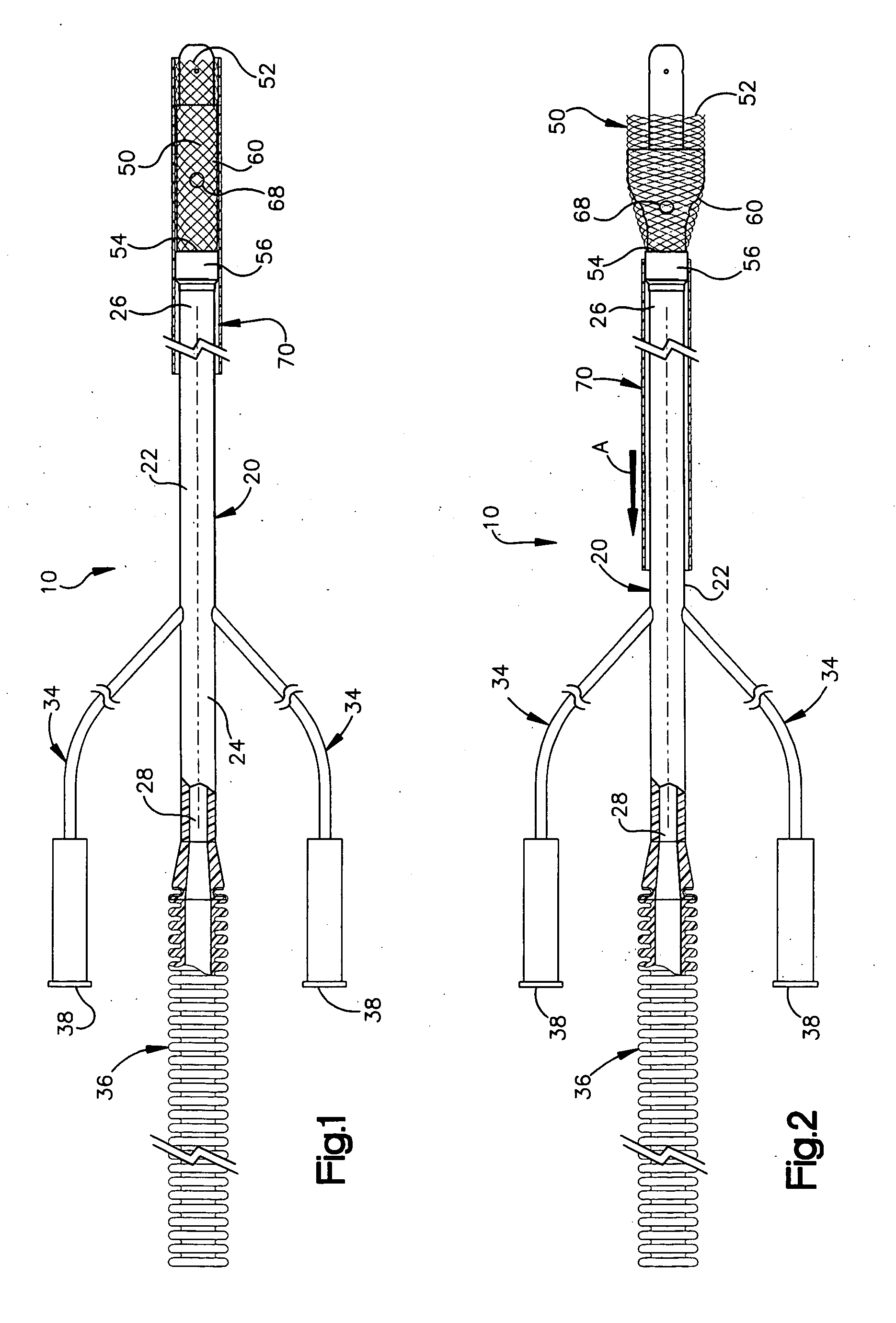 Apparatus and method for auto-retroperfusion of a coronary vein