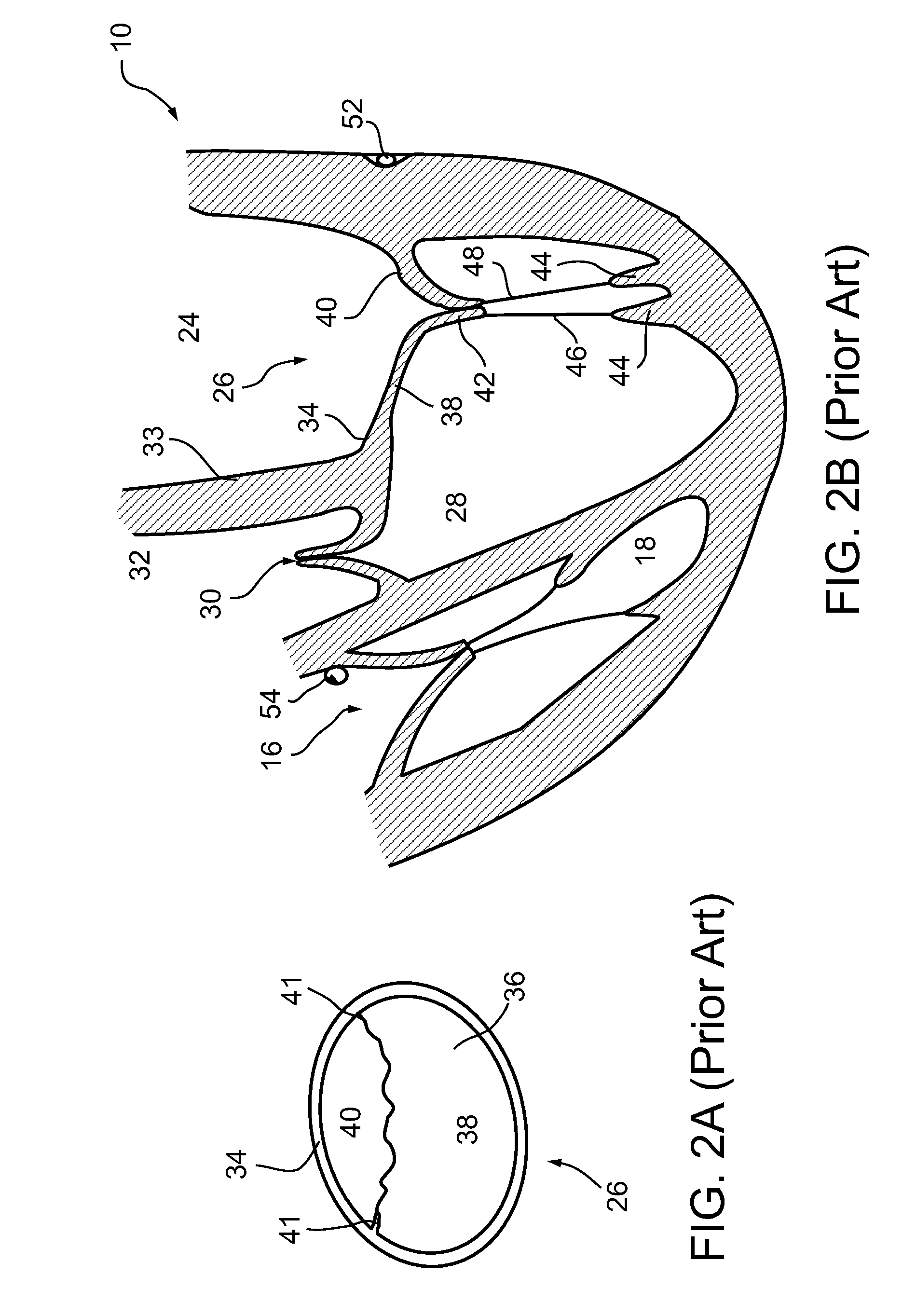 Access to the left atrium and reduction of mitral valve leaflet mobility