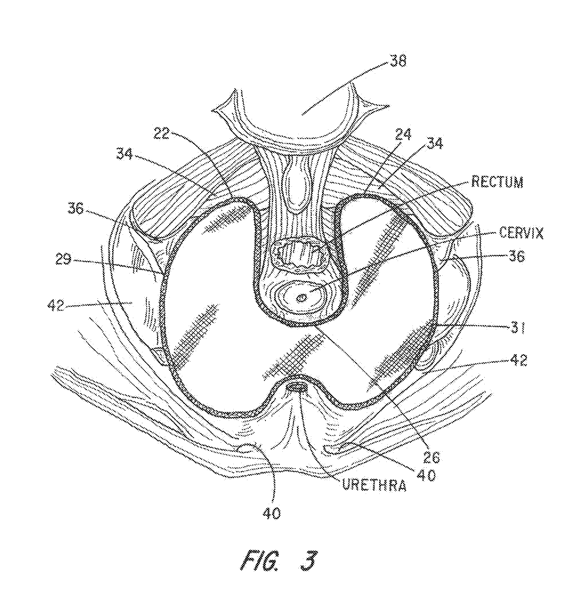 Apparatus and method for pelvic floor repair in the human female