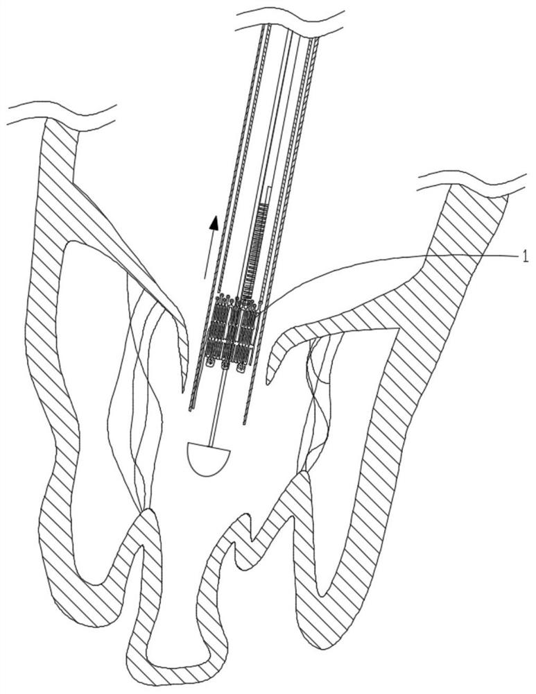 Multi-dimensional fixed heart valve prosthesis