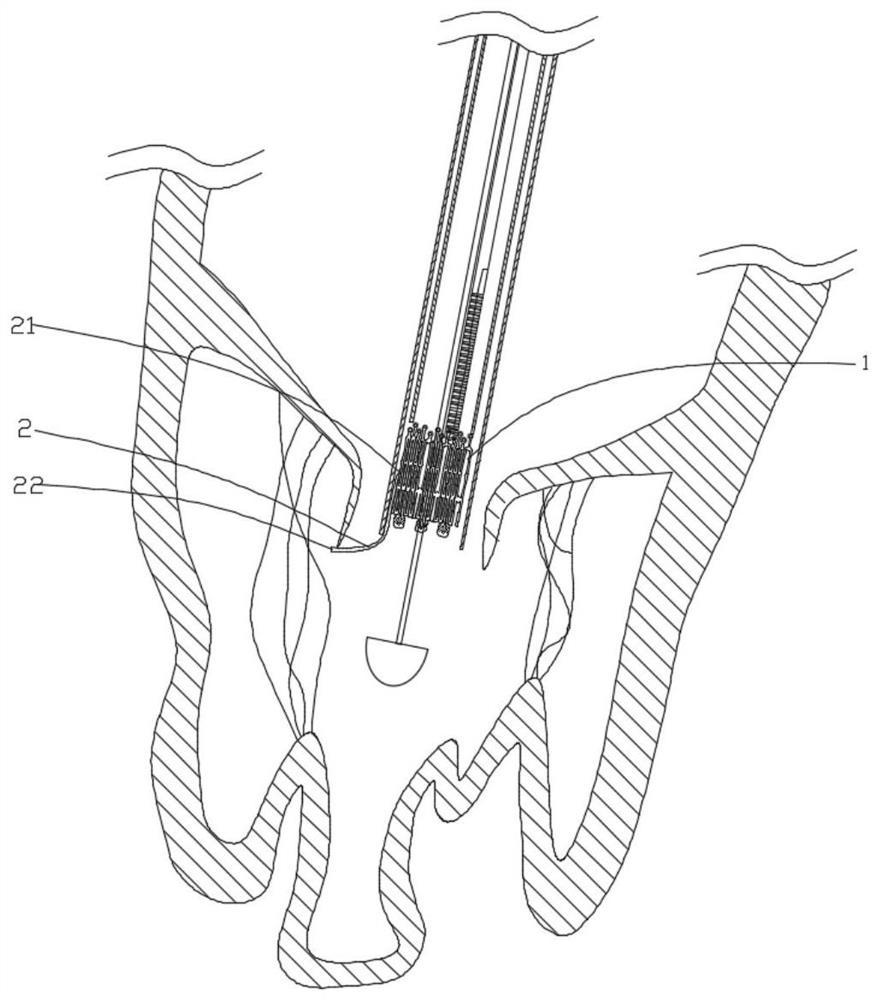 Multi-dimensional fixed heart valve prosthesis