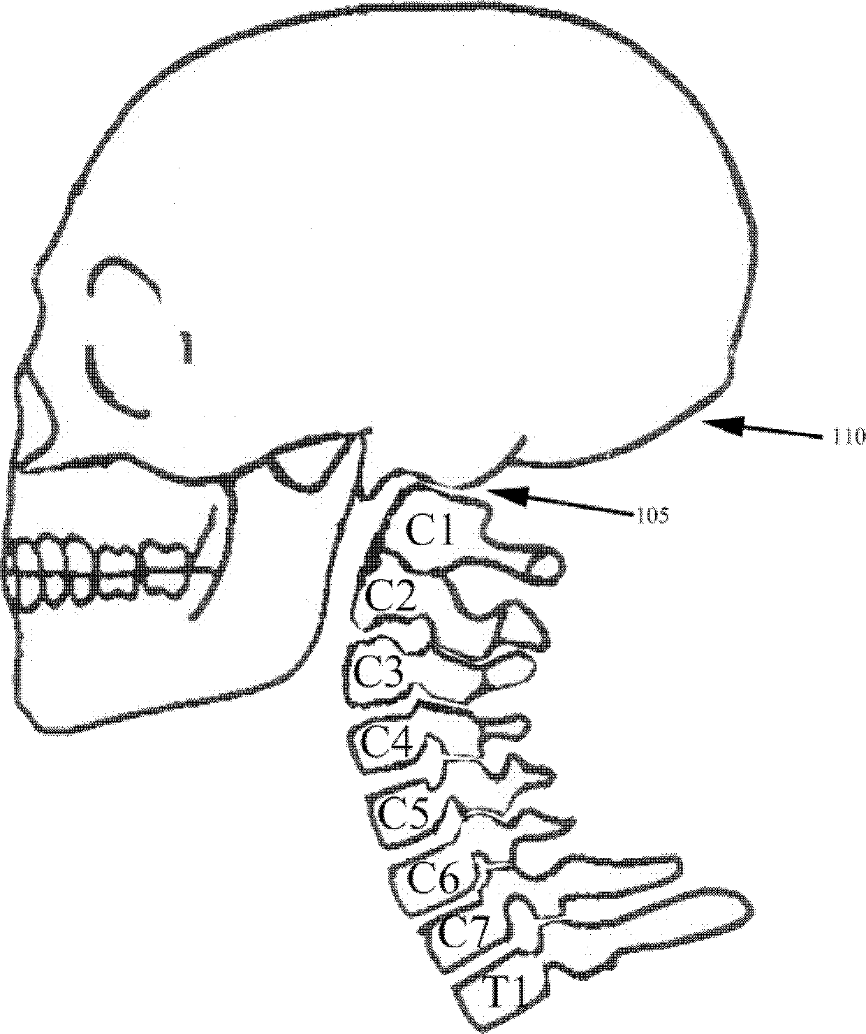 Patient interface equipment and method for aligning adjacent cervical vertebras by aid of same