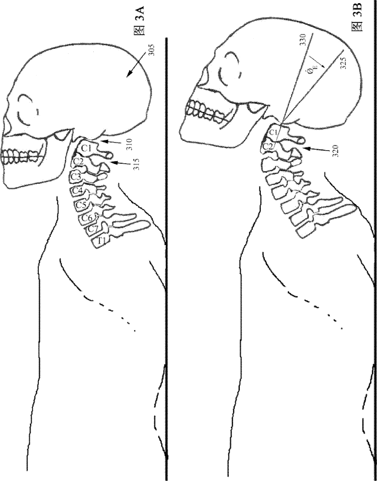 Patient interface equipment and method for aligning adjacent cervical vertebras by aid of same