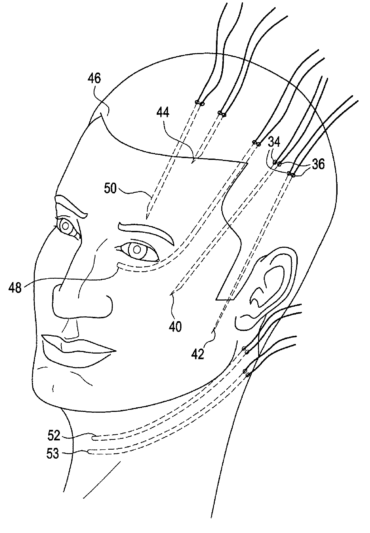 Surgical thread